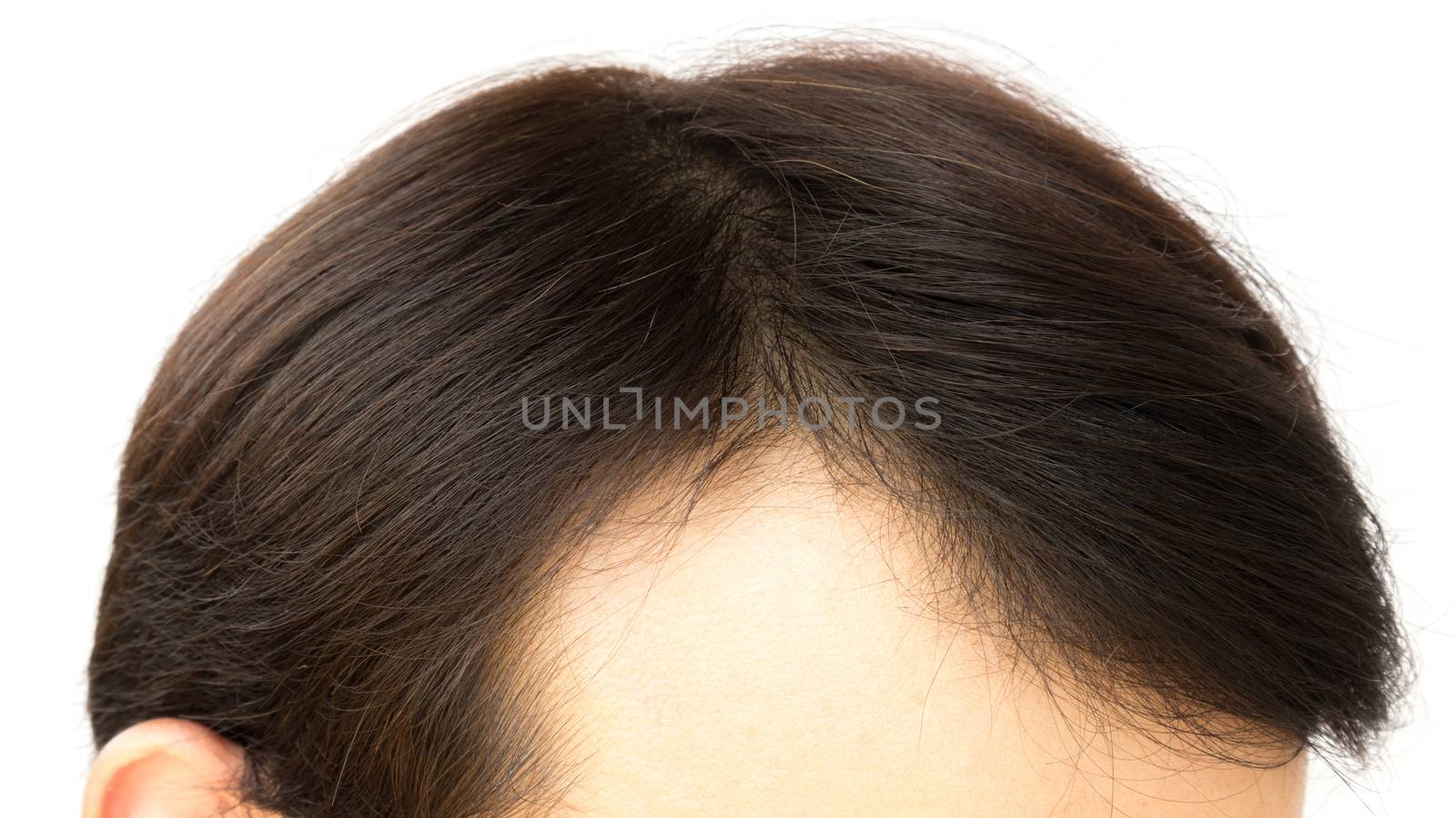 Young man serious hair loss problem for health care shampoo and beauty product concept