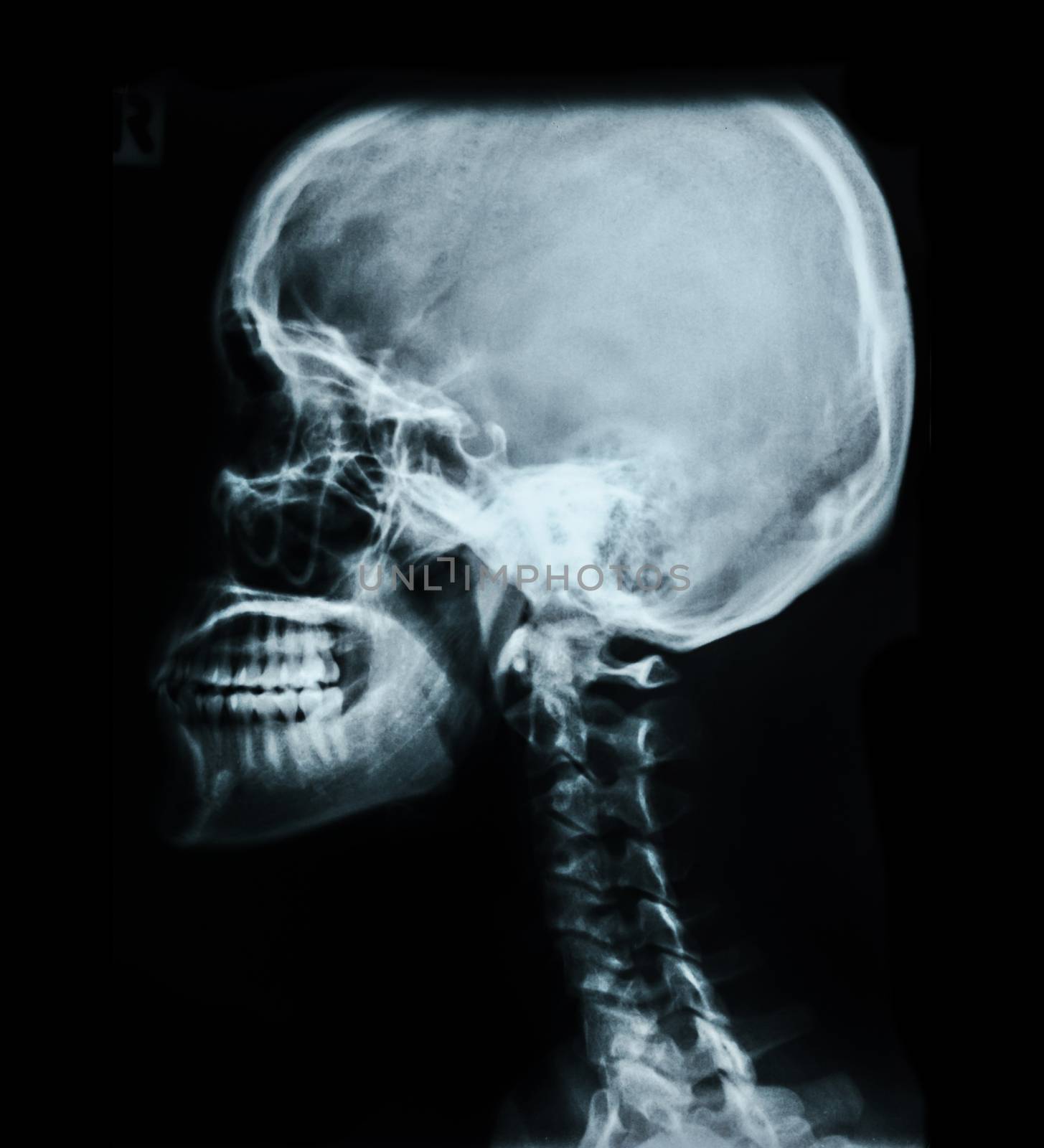 Human skull X-ray image. by Gamjai