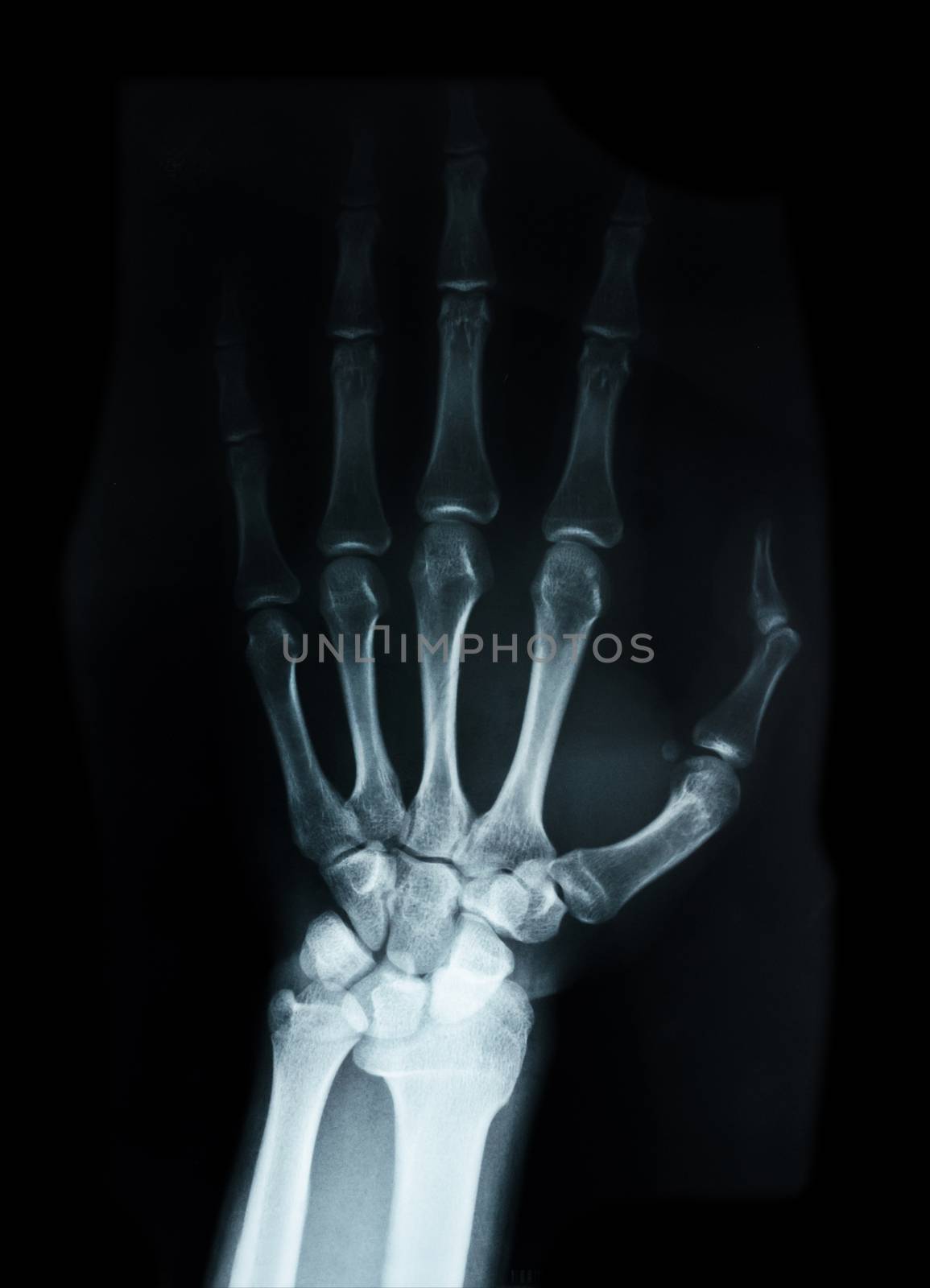 Carpal bones Human X Ray. by Gamjai