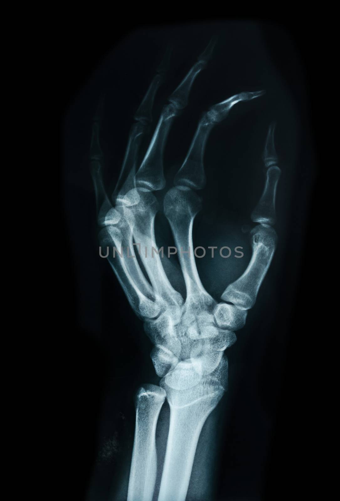 Carpal bones Human X Ray on black.