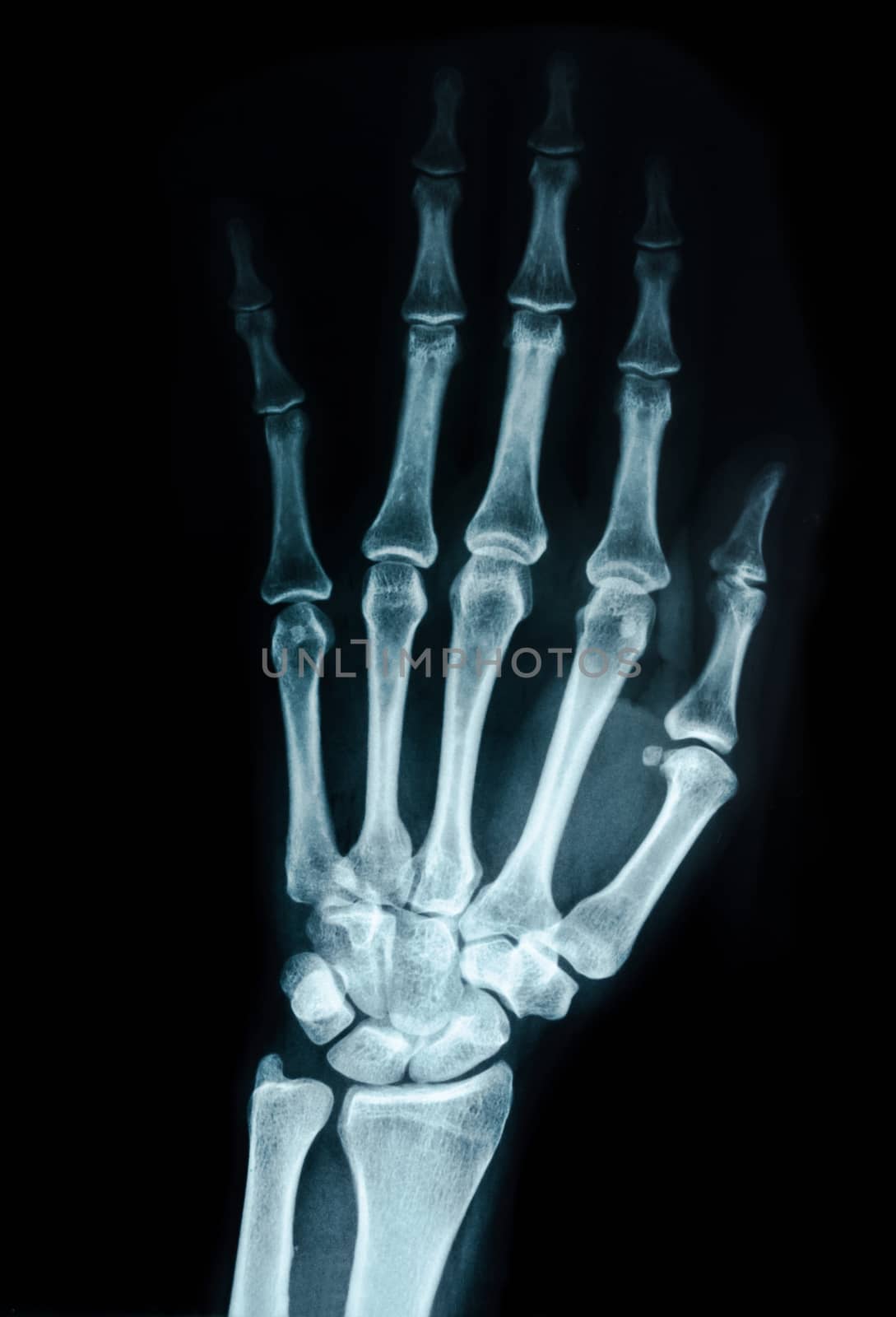 Hand x-ray view. by Gamjai