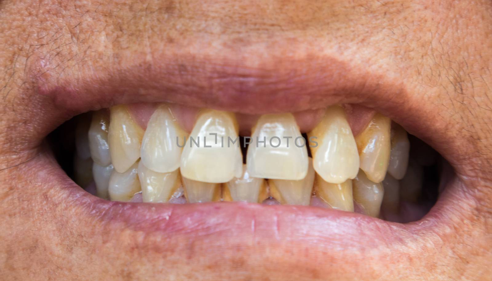 Closeup old woman teeth problems with gums or tartar for healthy dental concept