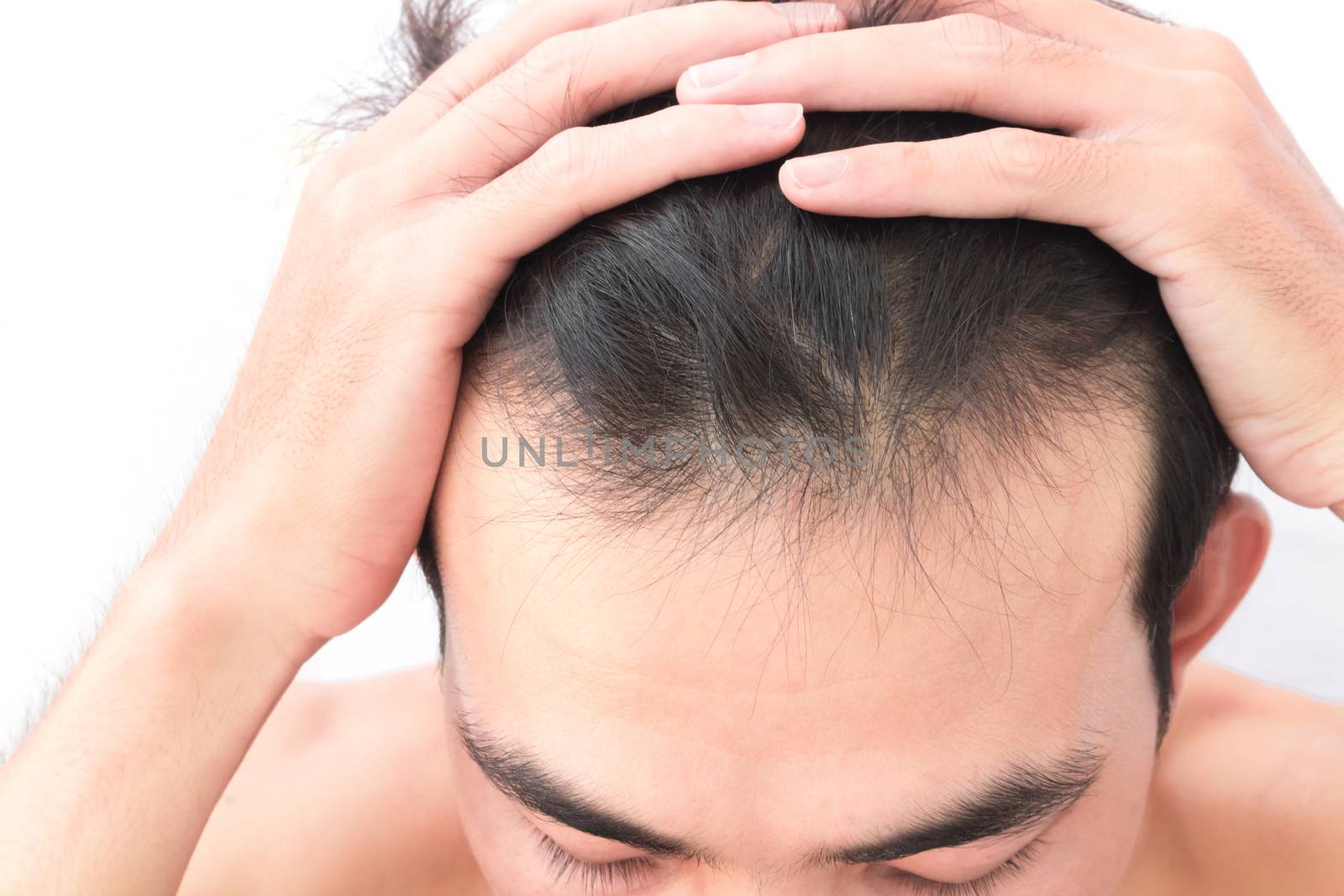 Young man worry hair loss problem for health care shampoo and be by pt.pongsak@gmail.com