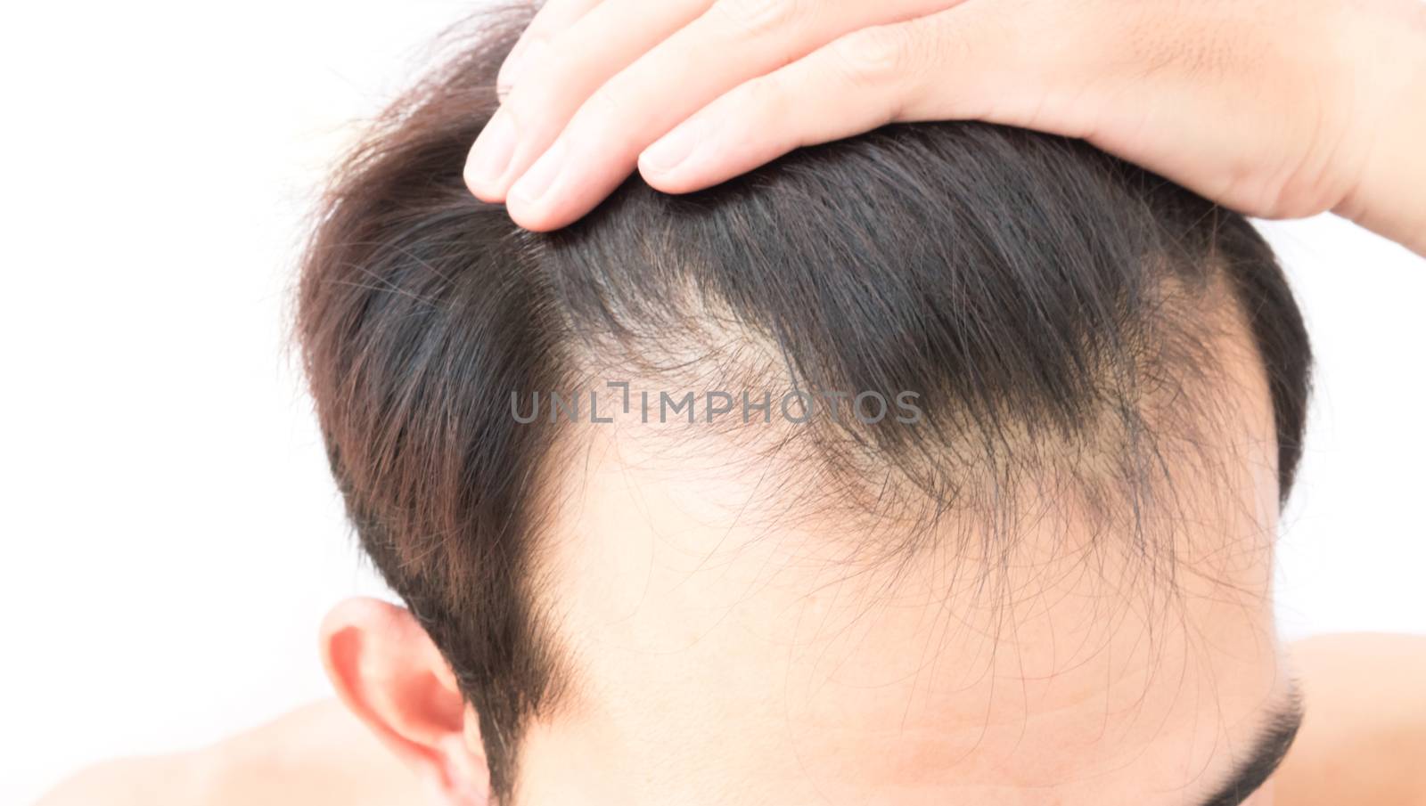 Young man worry hair loss problem for health care shampoo and be by pt.pongsak@gmail.com