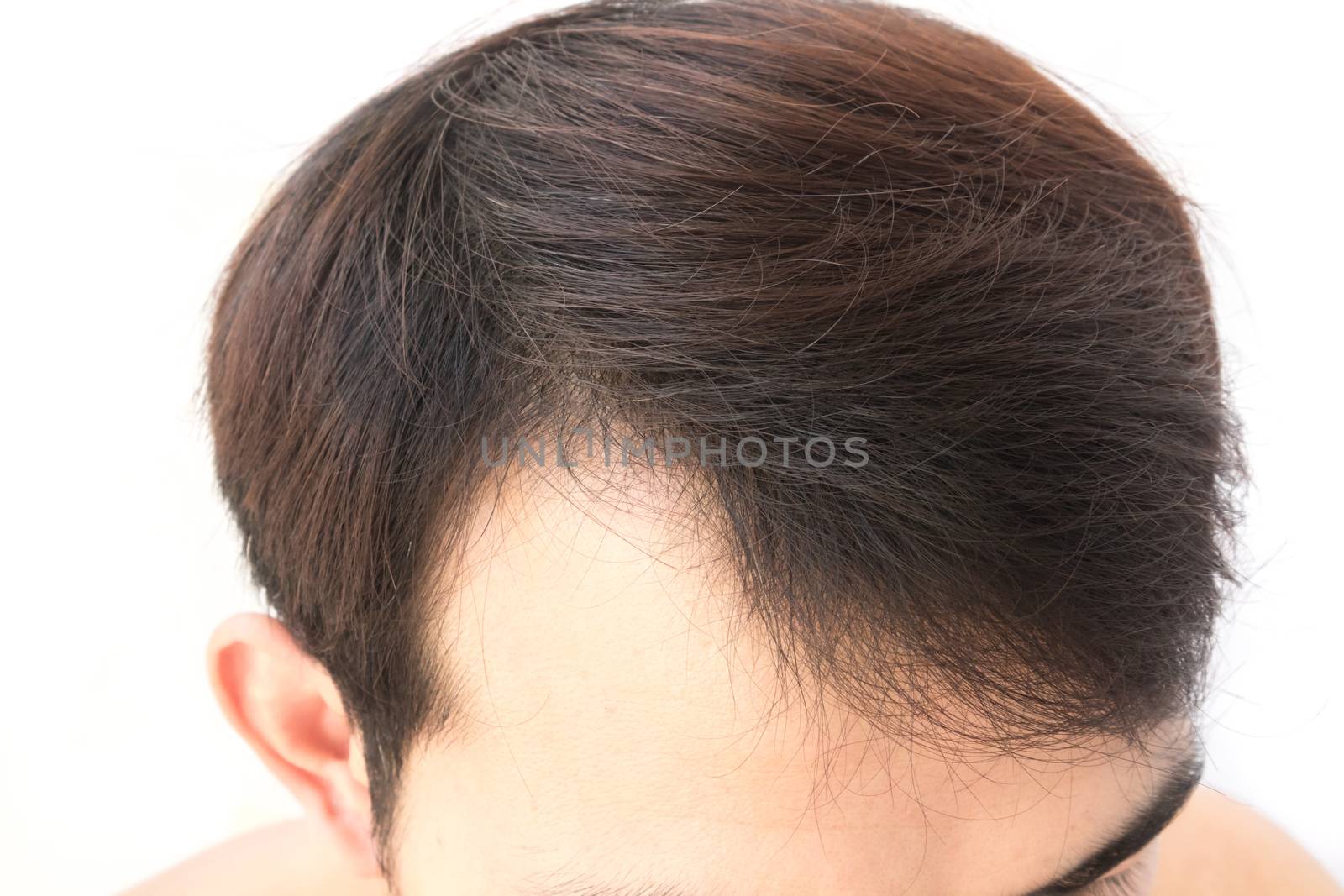 Young man worry hair loss problem for health care shampoo and be by pt.pongsak@gmail.com