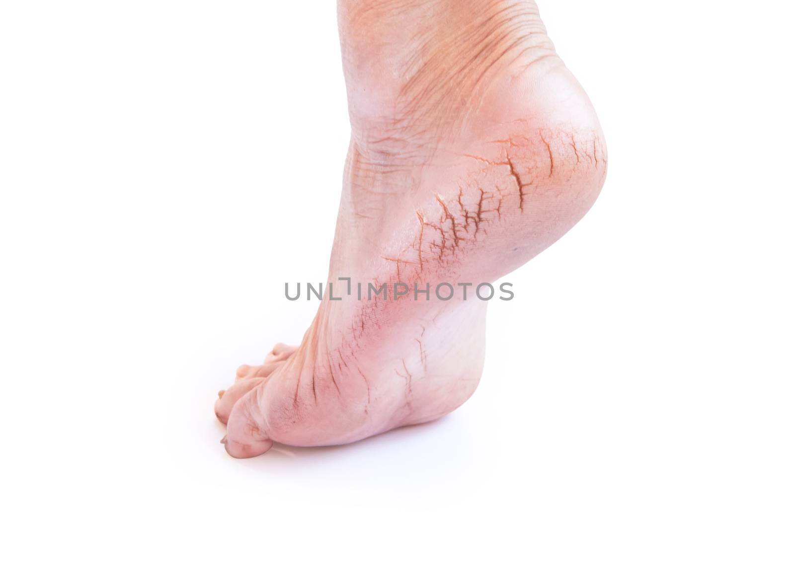 Woman cracked heels with white background, foot healthy concept