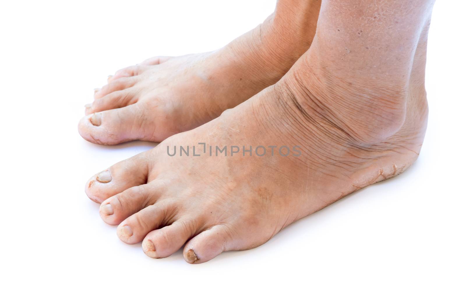 Closeup woman cracked feet and heels with white background, healthy concept