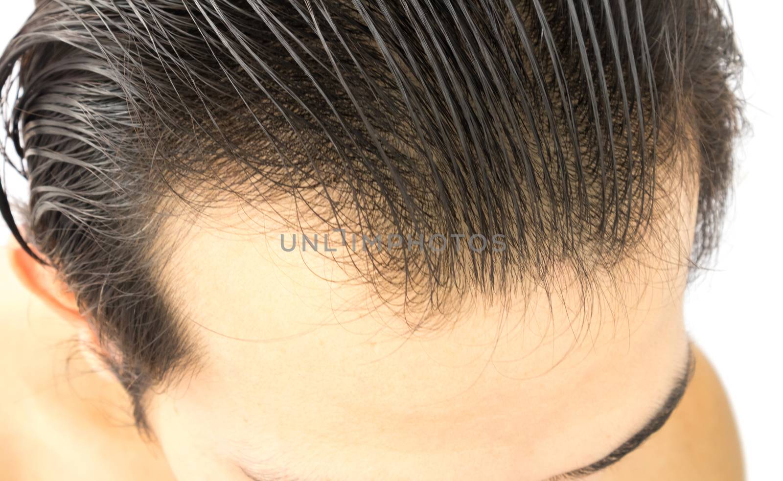 Closeup young man serious hair loss problem for health care sham by pt.pongsak@gmail.com