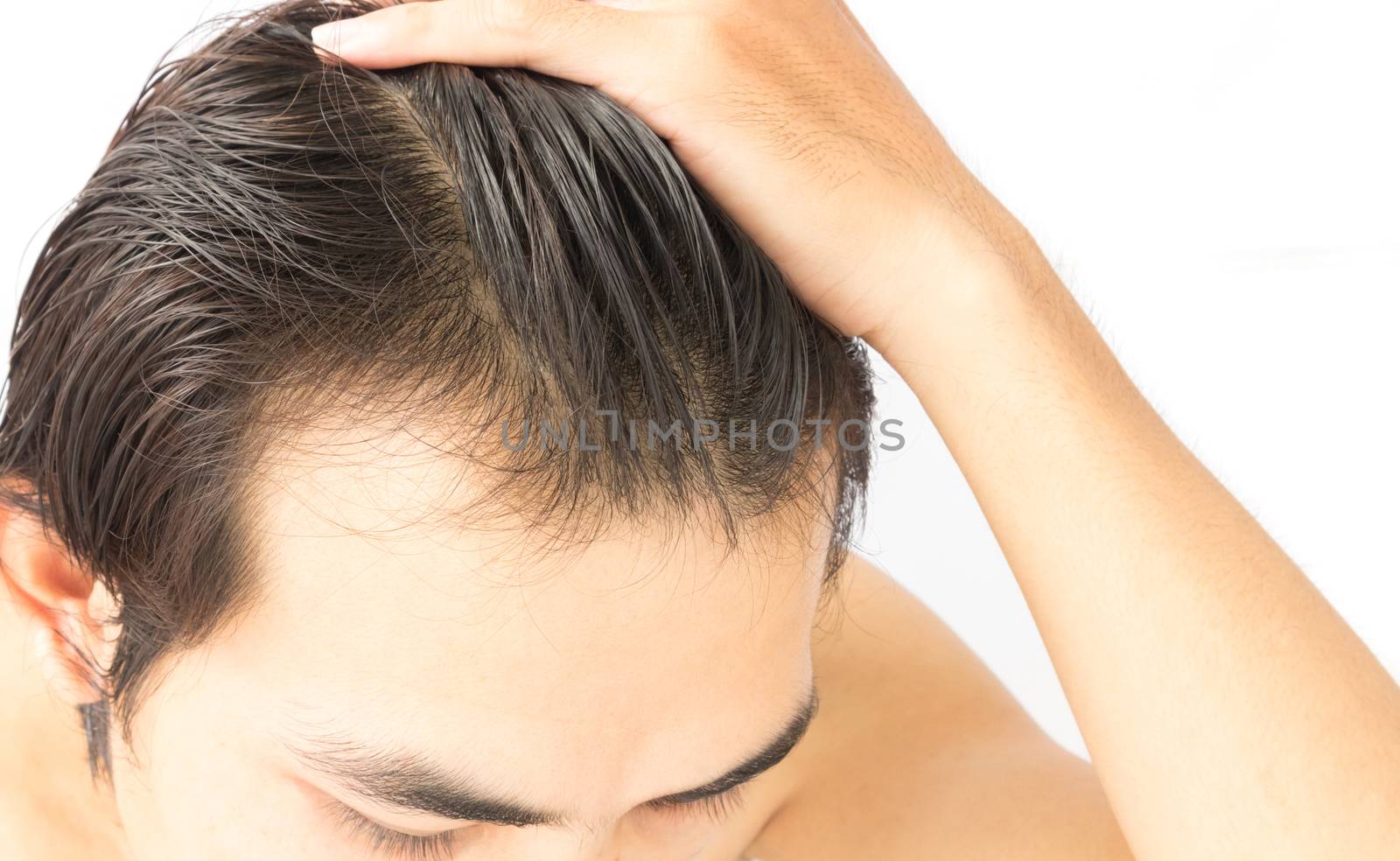 Closeup young man serious hair loss problem for health care sham by pt.pongsak@gmail.com
