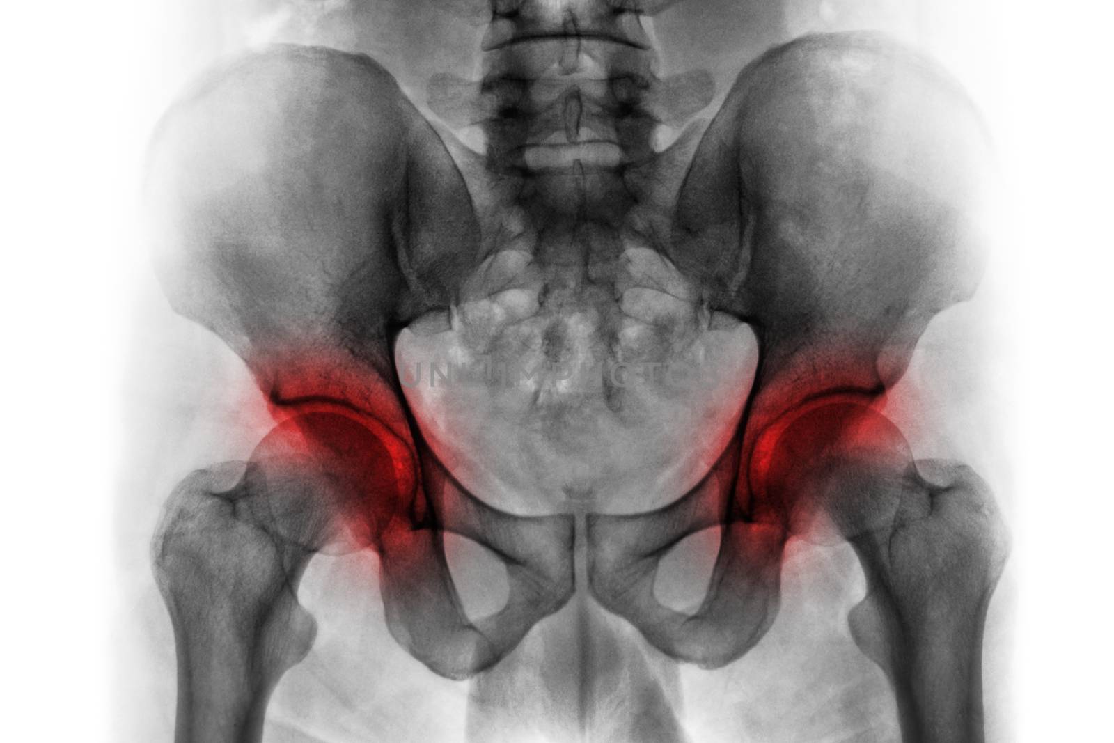 Arthritis both hip . Film x-ray of human pelvis . by stockdevil