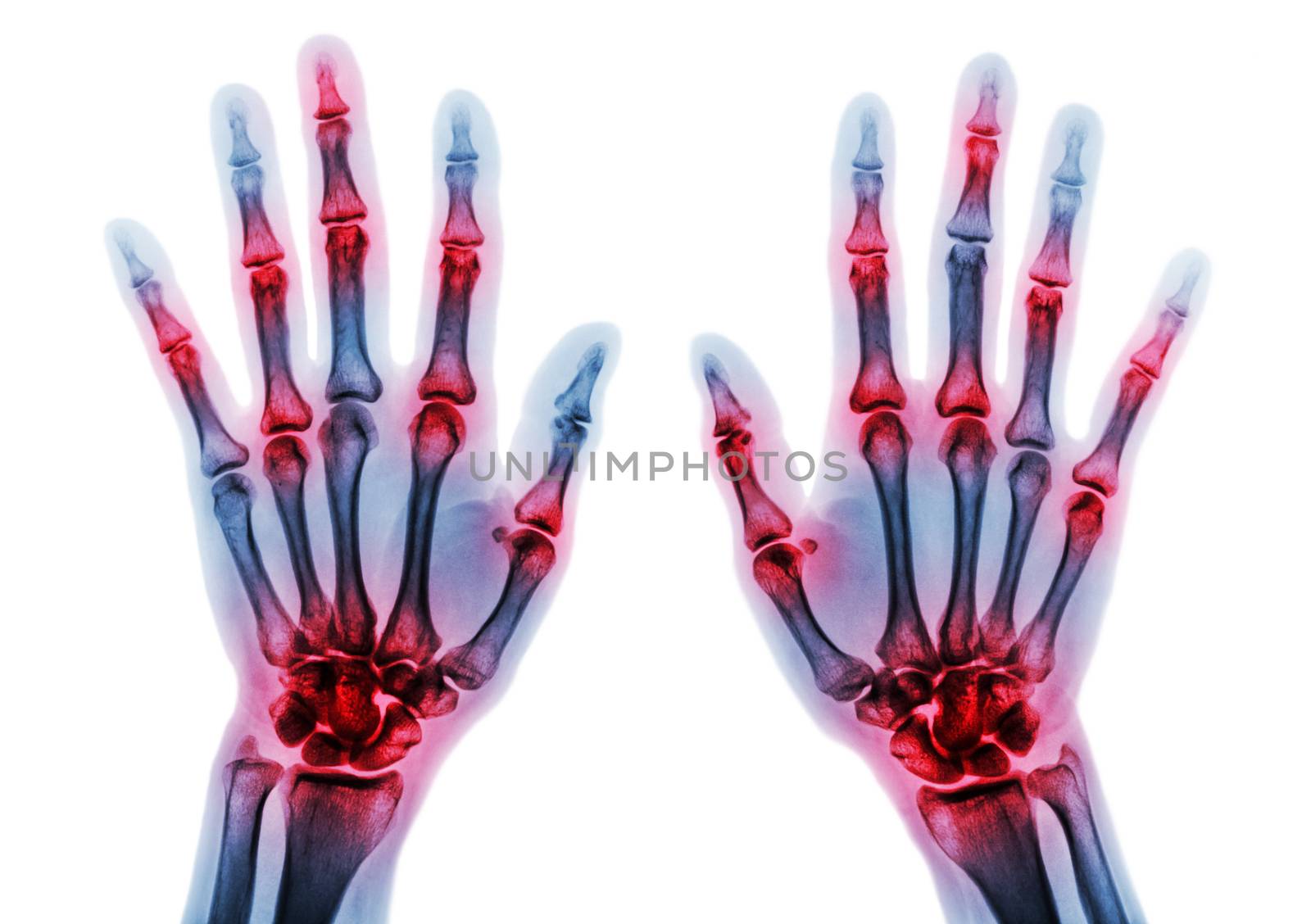 Arthritis multiple joint of fingers . Film x-ray of both hands and wrists . by stockdevil