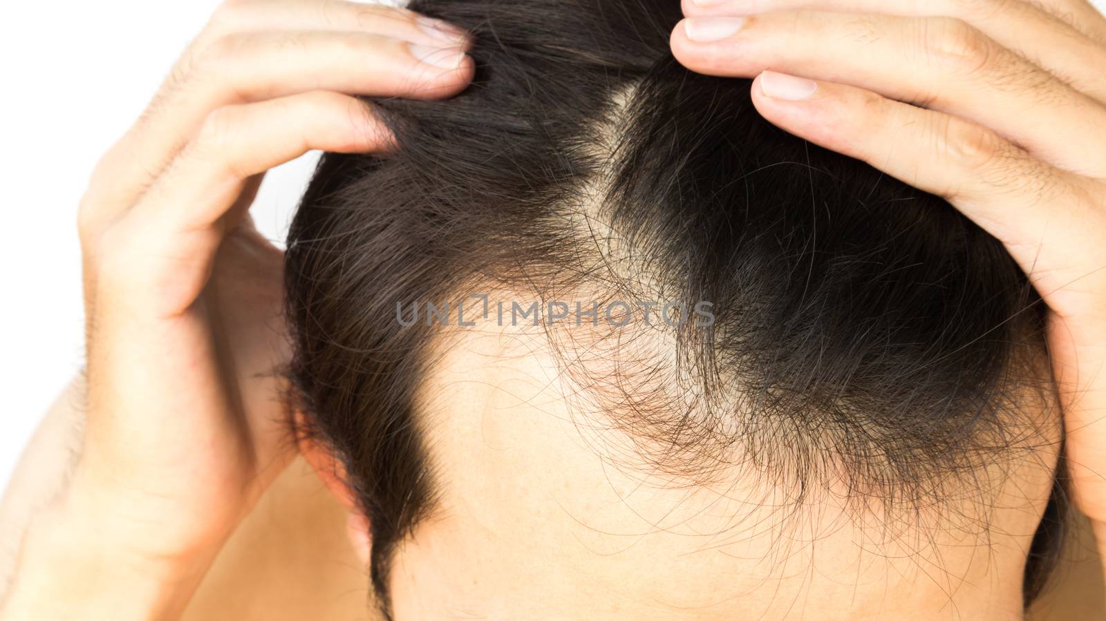Young man serious hair loss problem for health care shampoo and beauty product concept
