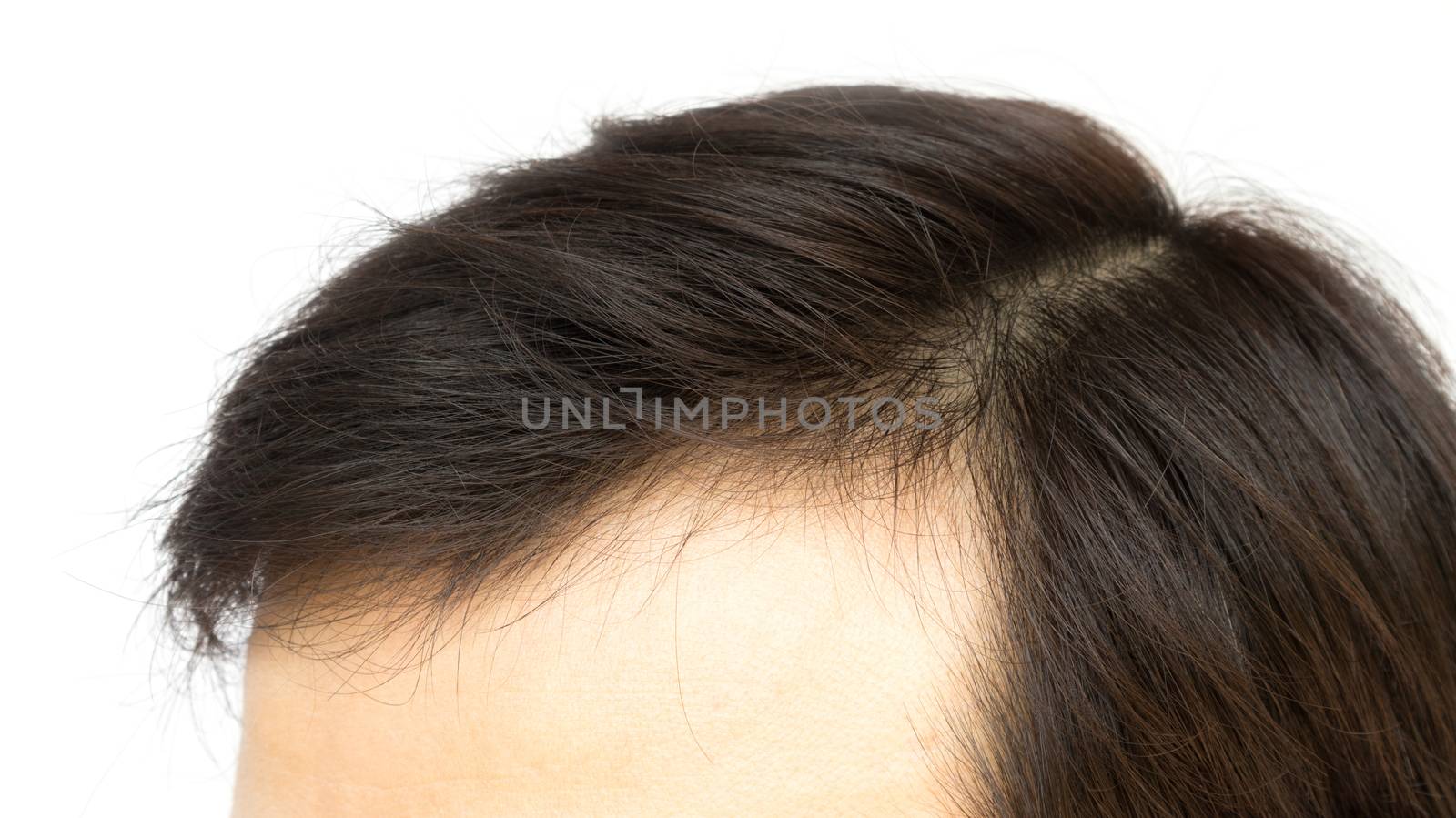 Young man serious hair loss problem for health care shampoo and beauty product concept