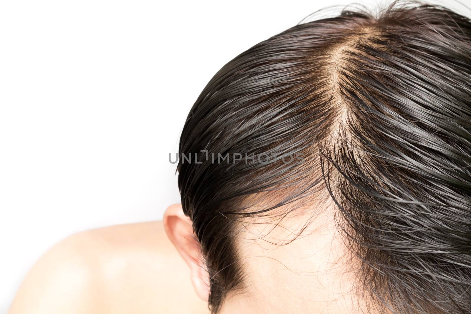 Closeup young man serious hair loss problem for hair loss concep by pt.pongsak@gmail.com