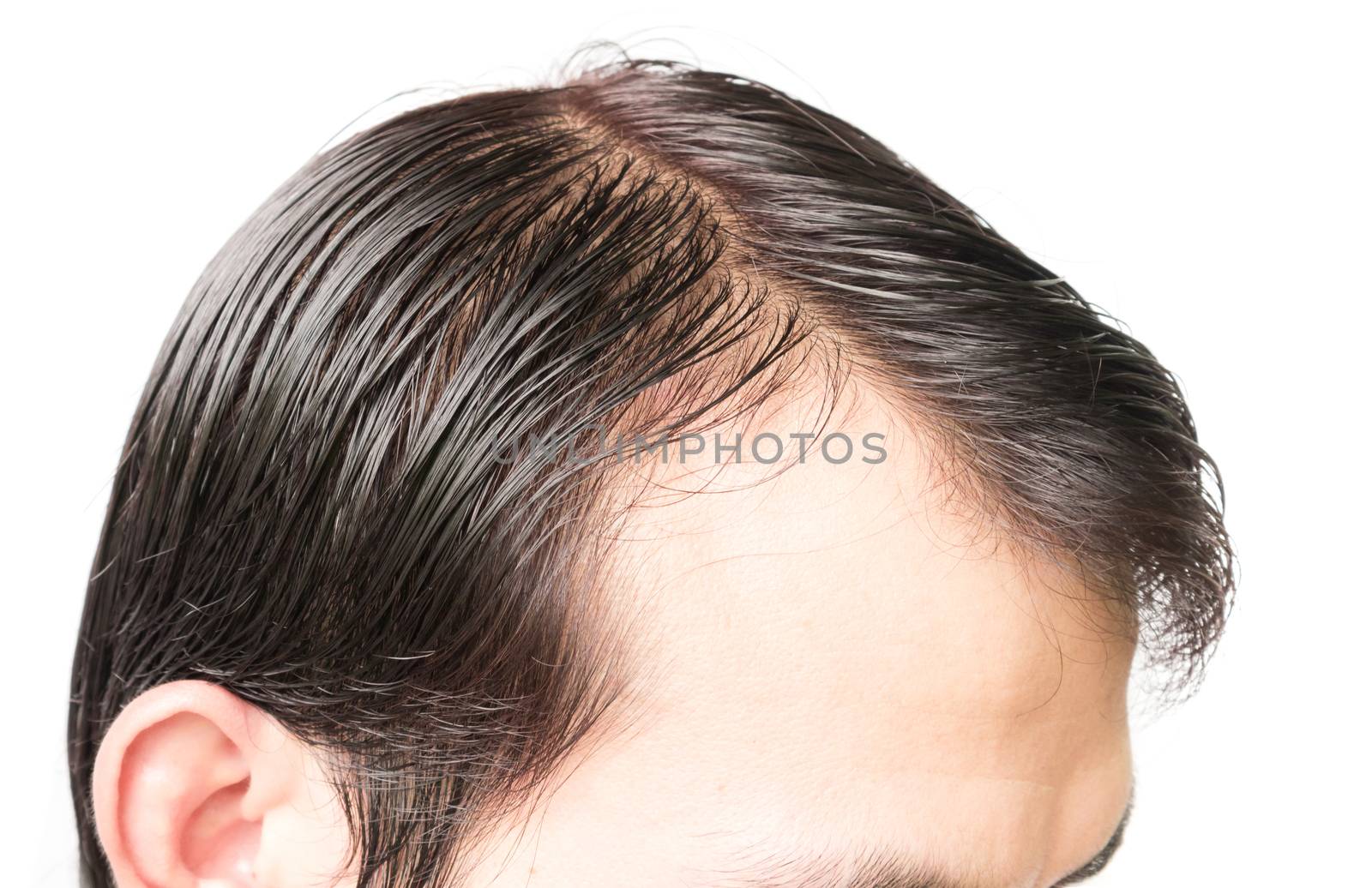 Closeup young man serious hair loss problem for hair loss concep by pt.pongsak@gmail.com