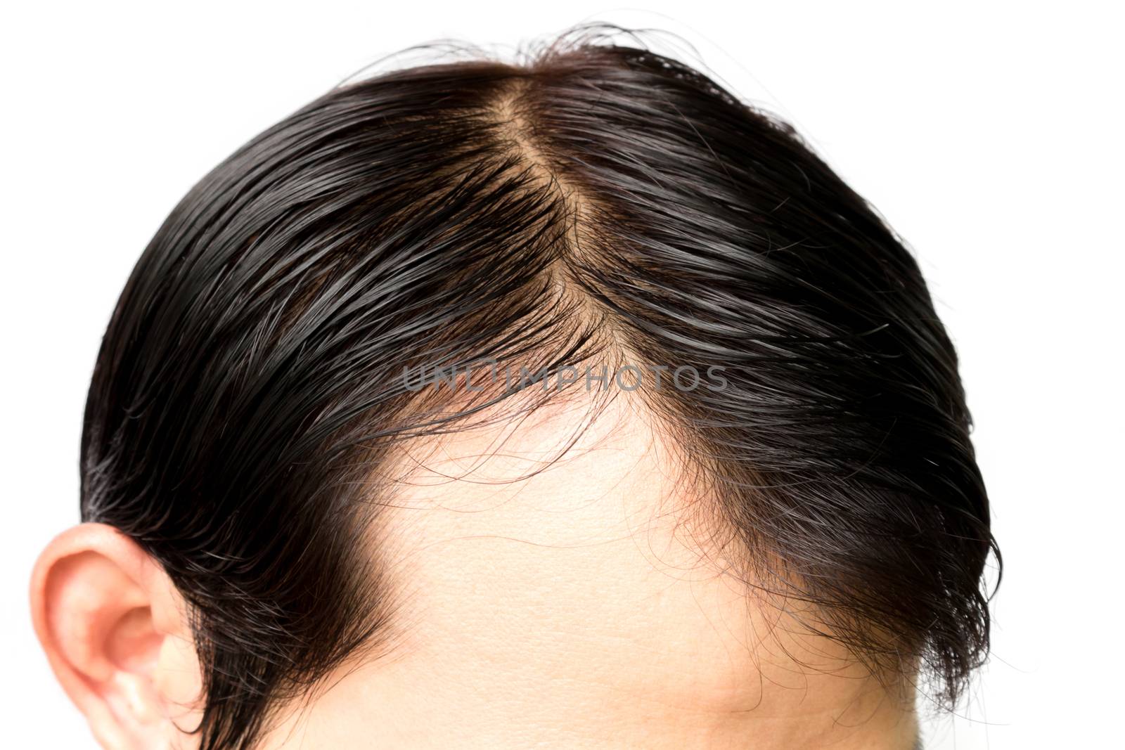 Closeup young man serious hair loss problem for hair loss concep by pt.pongsak@gmail.com