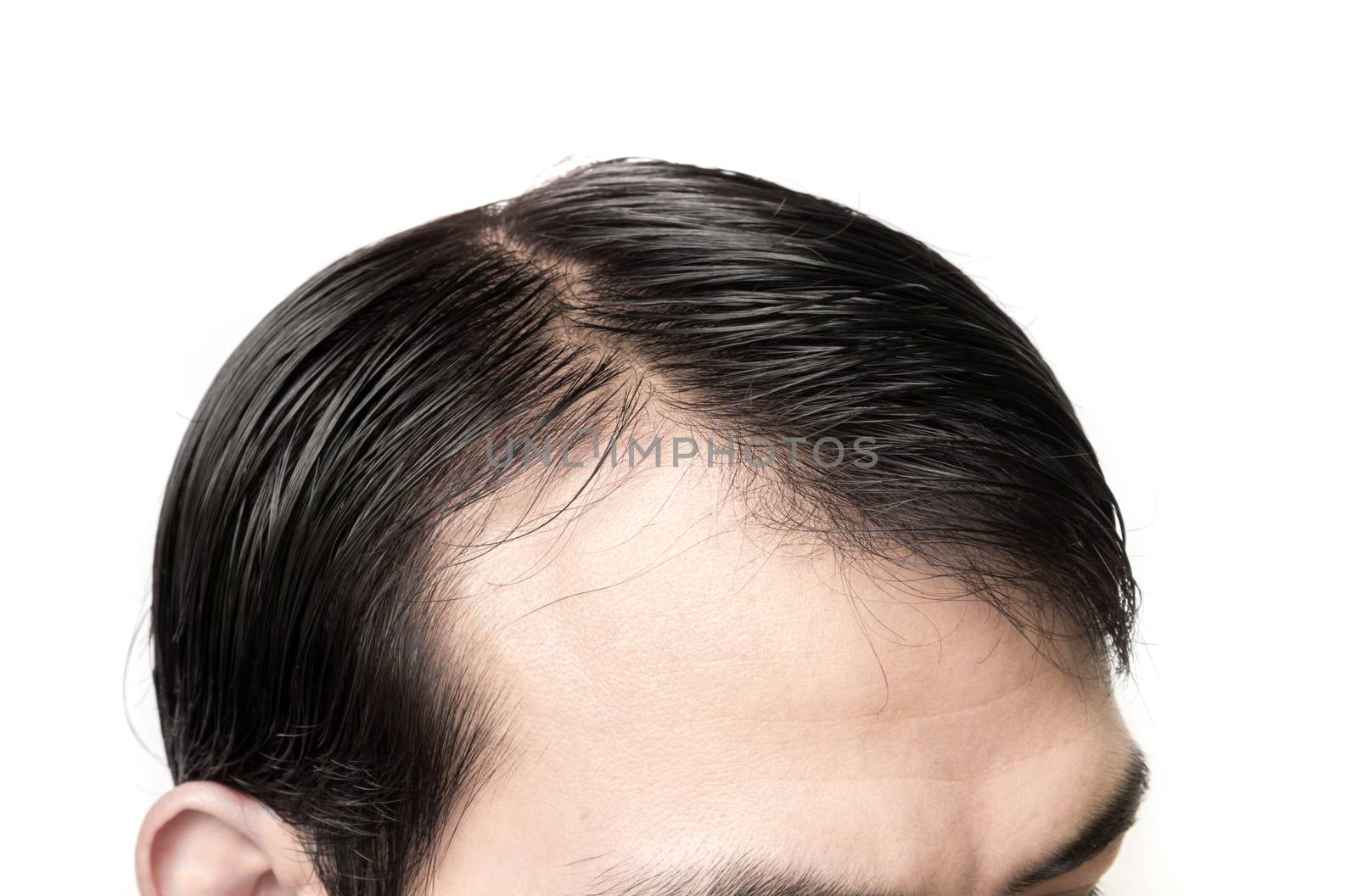 Closeup young man serious hair loss problem for hair loss concep by pt.pongsak@gmail.com