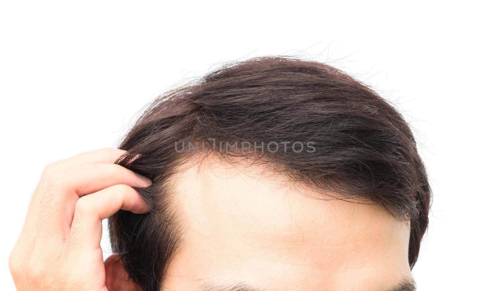 Closeup young man serious hair loss problem for hair loss concept