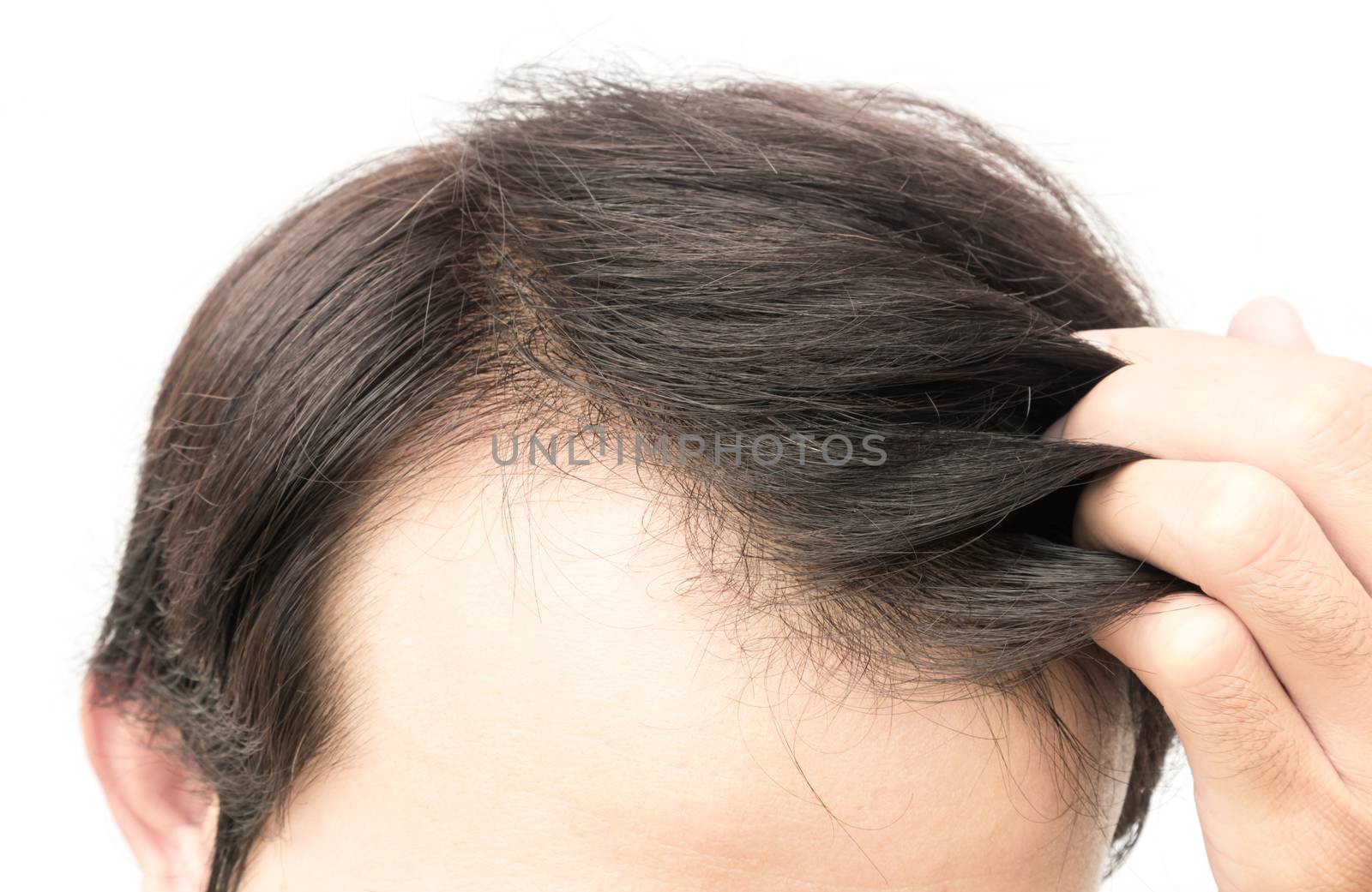 Closeup young man serious hair loss problem for hair loss concep by pt.pongsak@gmail.com