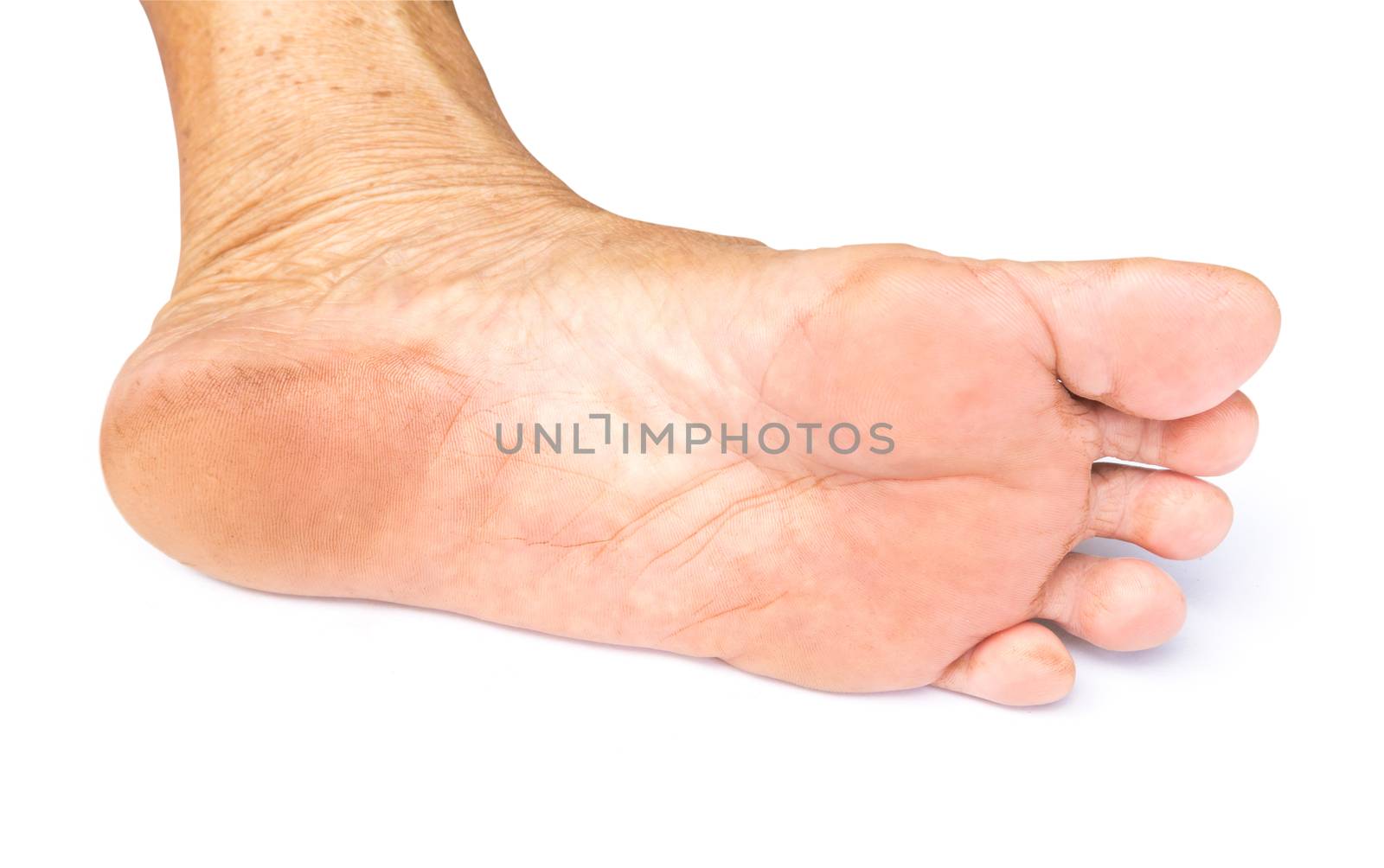 Closeup woman cracked feet and heels on white background with clipping path, healthy concept