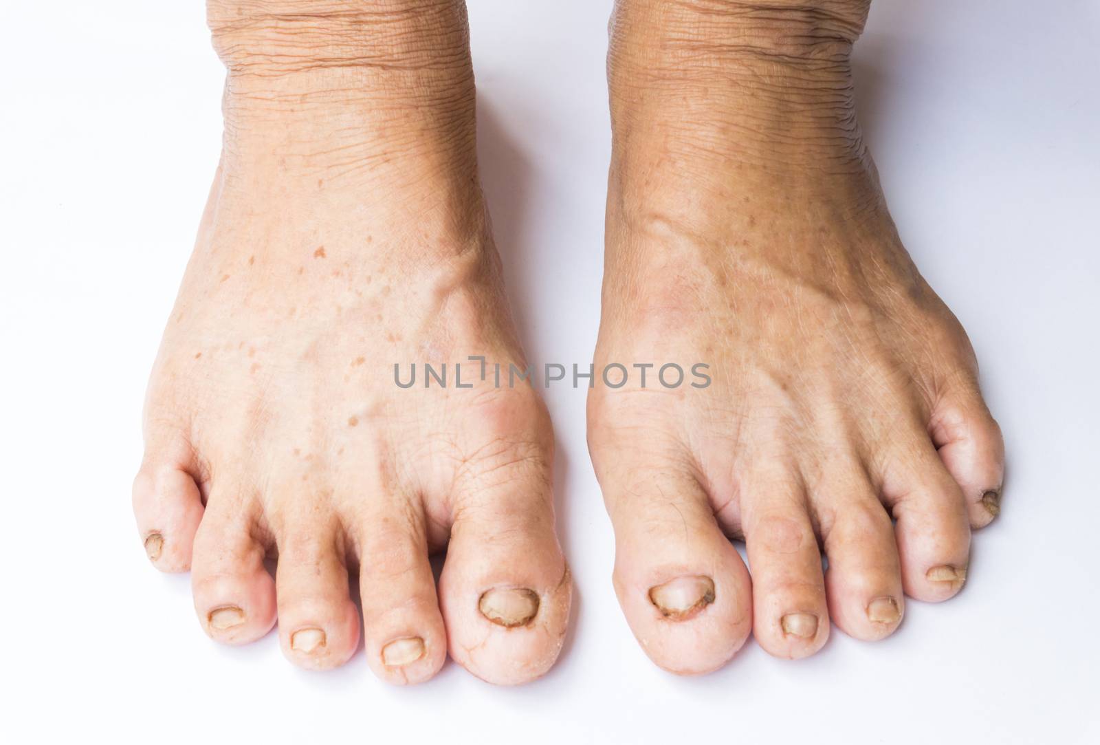 Closeup woman cracked feet and heels on white background, healthy concept