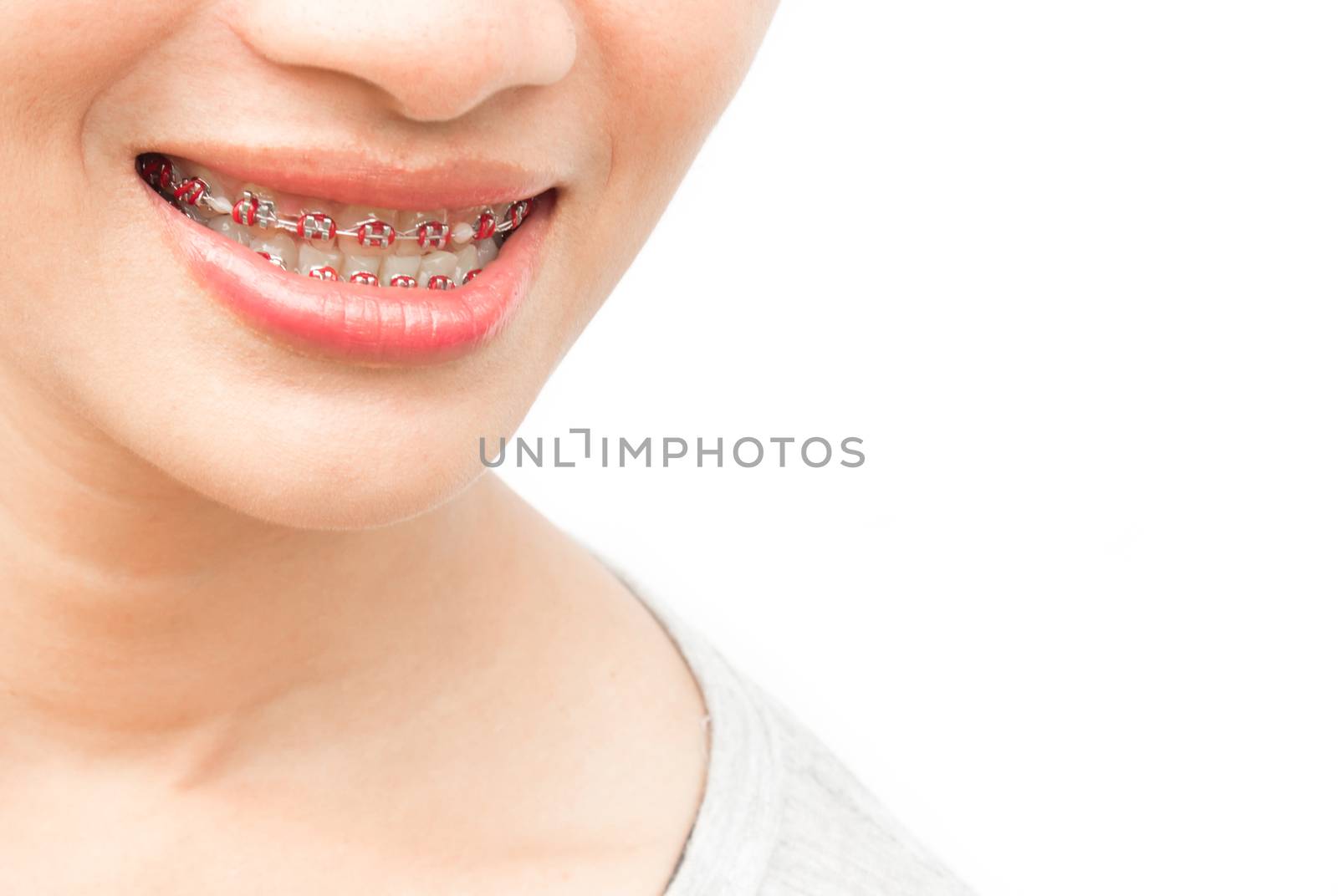Close up woman smiling with Ceramic and Metal Braces on white ba by pt.pongsak@gmail.com