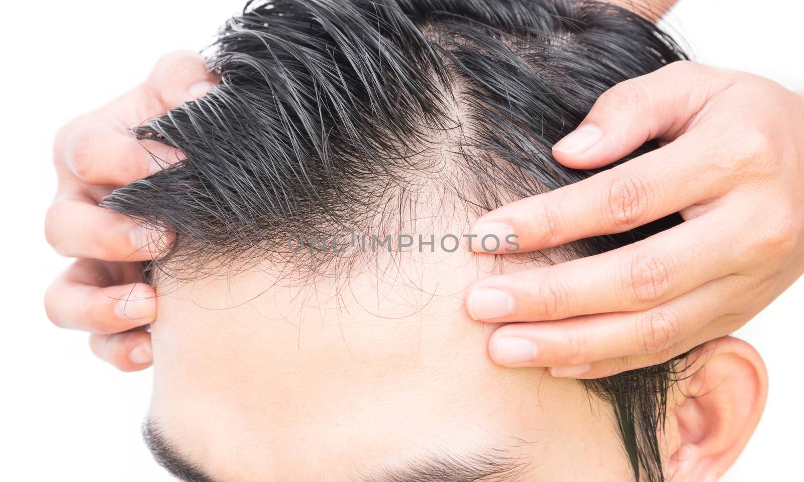 Young man serious hair loss problem for hair loss concept by pt.pongsak@gmail.com
