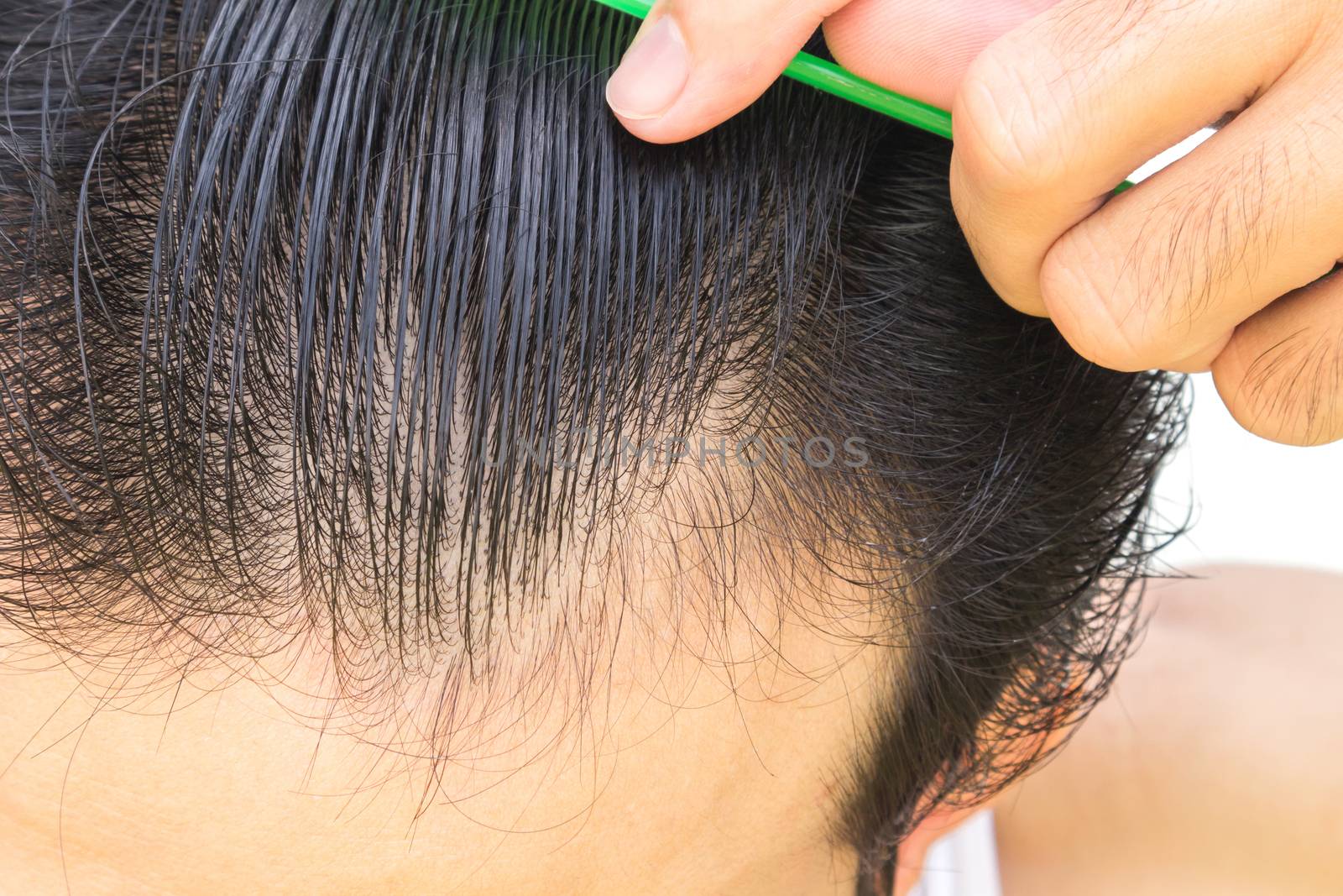 Young man serious hair loss problem for hair loss concept by pt.pongsak@gmail.com