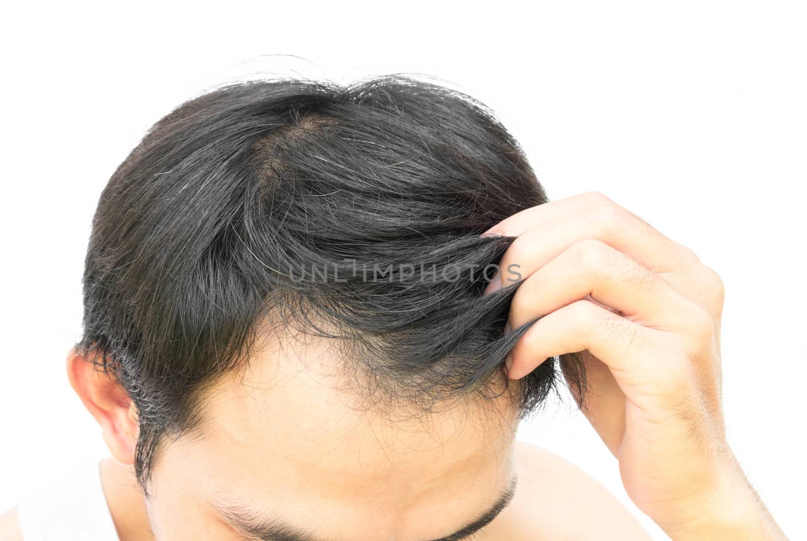 Closeup young man serious hair loss problem for hair loss concept or health care shampoo product on white background