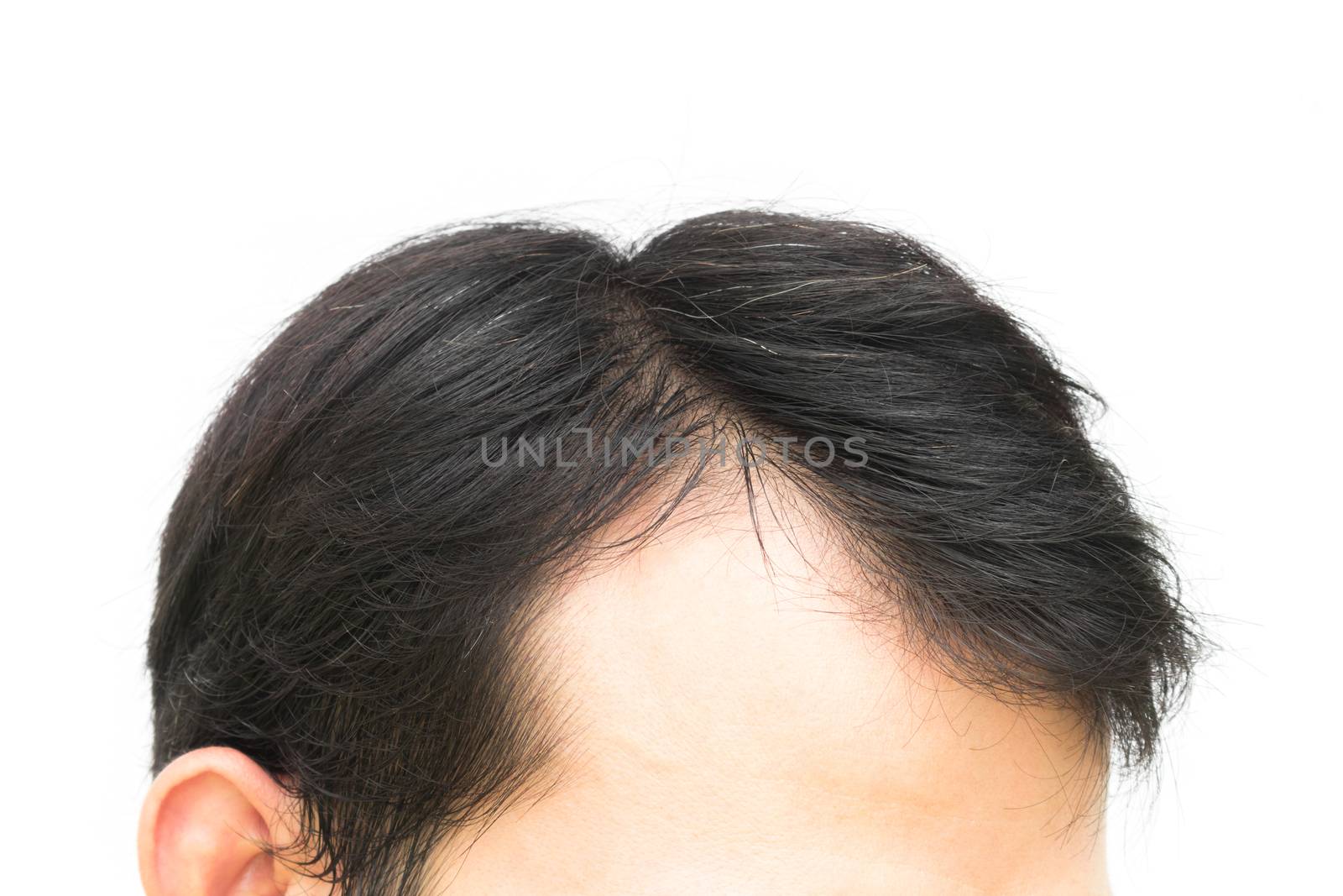 Closeup young man serious hair loss problem for hair loss concep by pt.pongsak@gmail.com