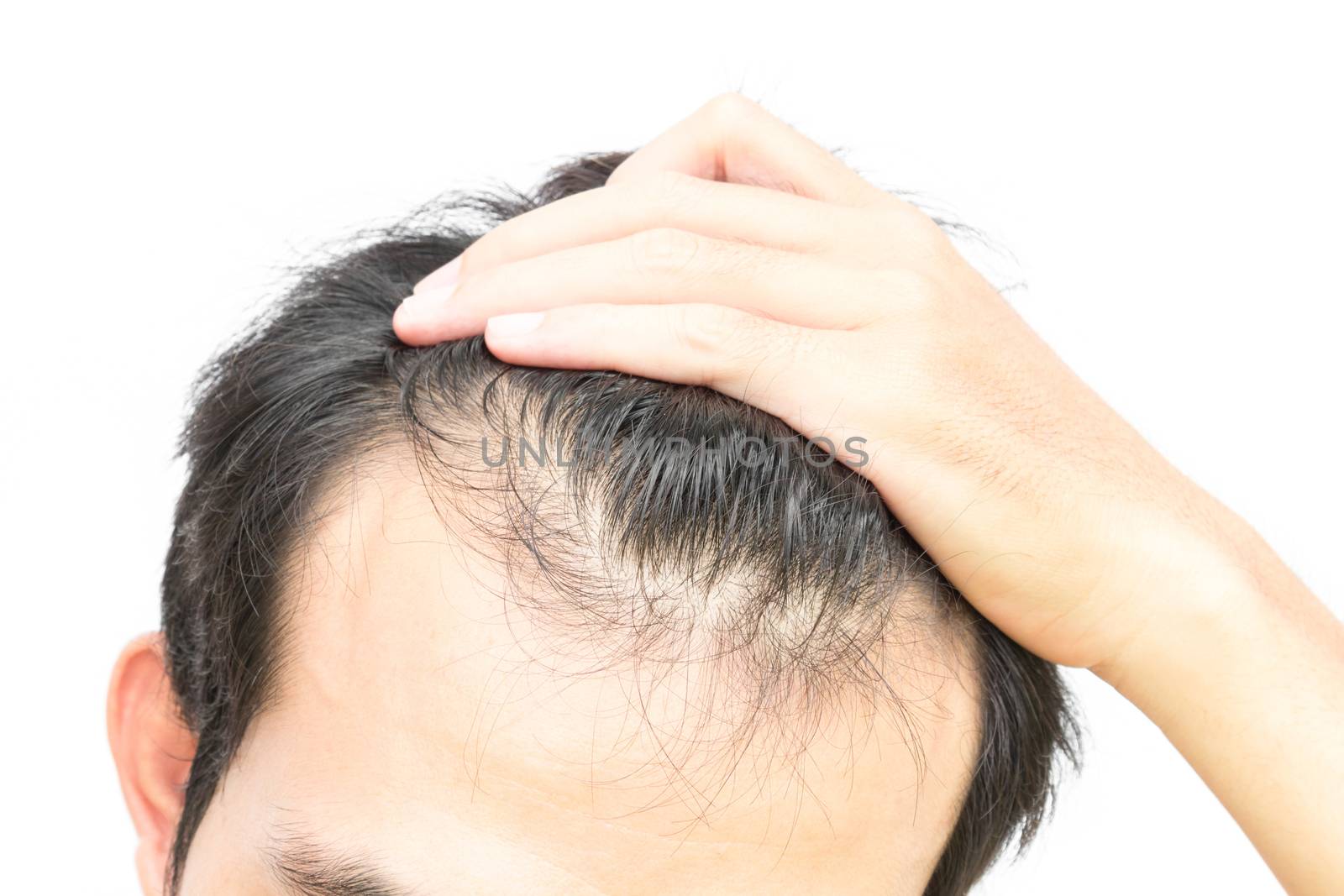 Closeup young man serious hair loss problem for hair loss concept or health care shampoo product on white background