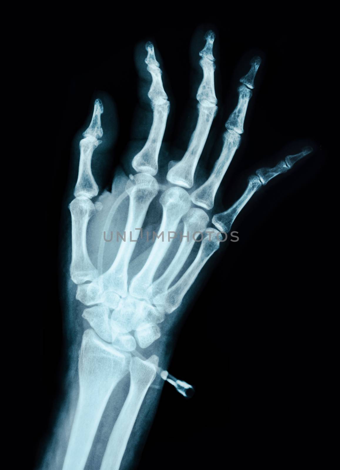 Human Left hand on device x ray. by Gamjai