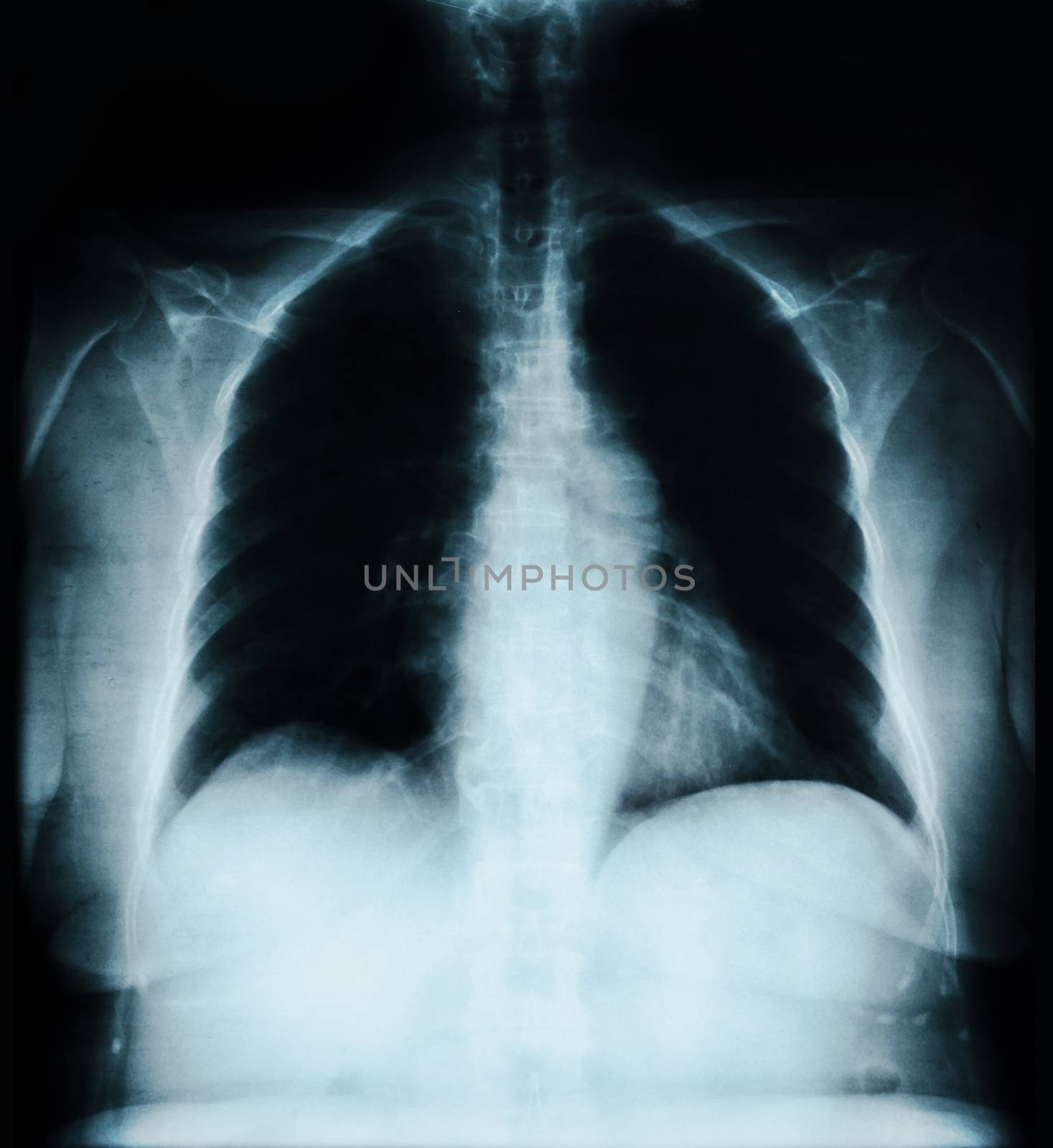 X-ray lung image on black.