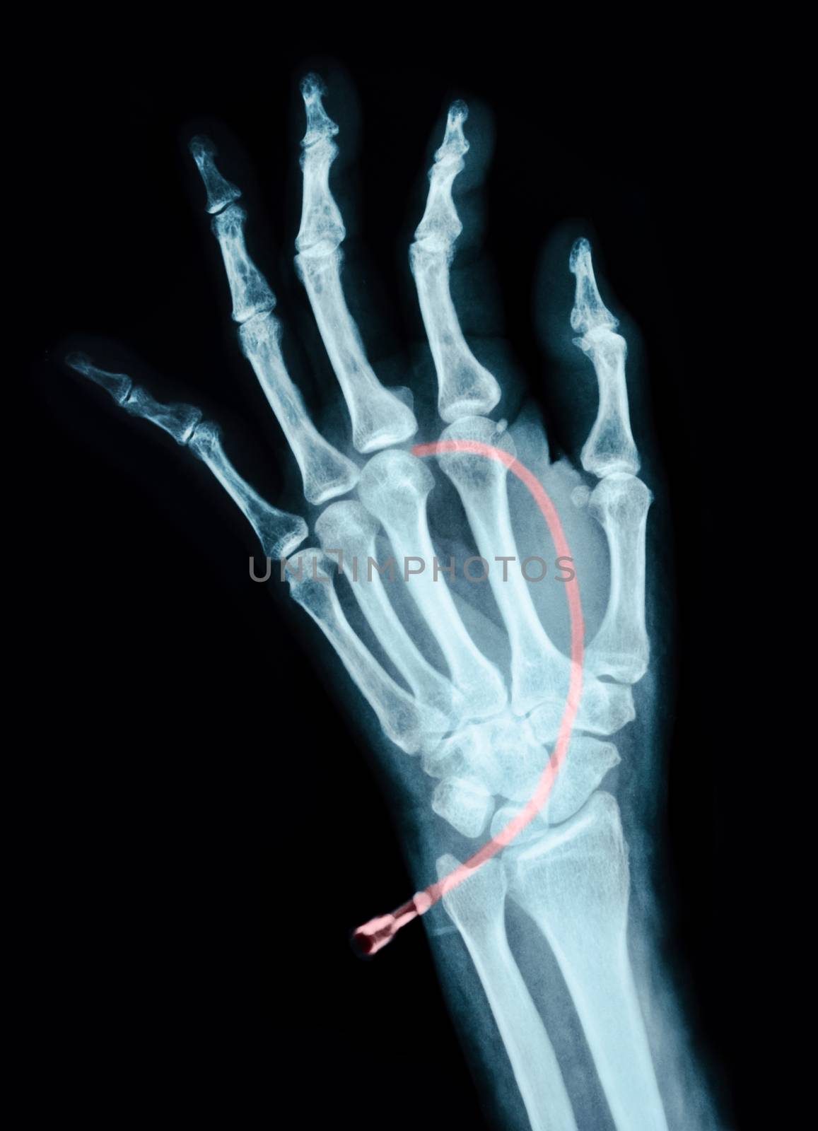 Human Left hand on device x ray - Medical Image