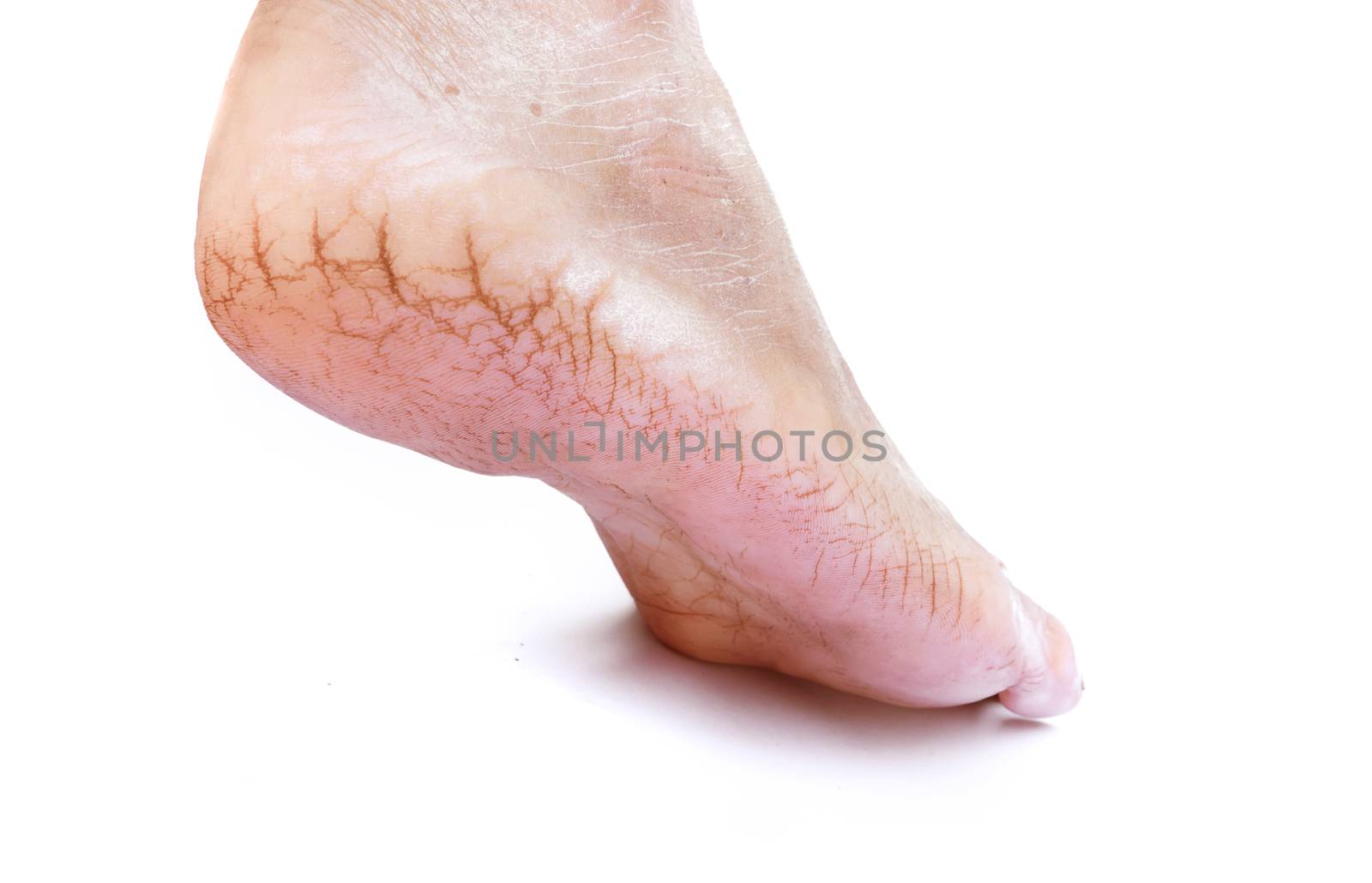 Woman cracked heels with white background, foot healthy concept