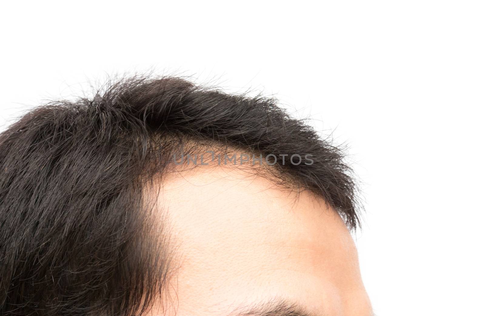 Young man serious hair loss problem for hair loss concept