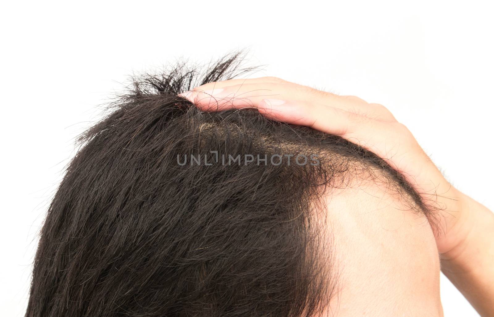 Young man serious hair loss problem for hair loss concept
