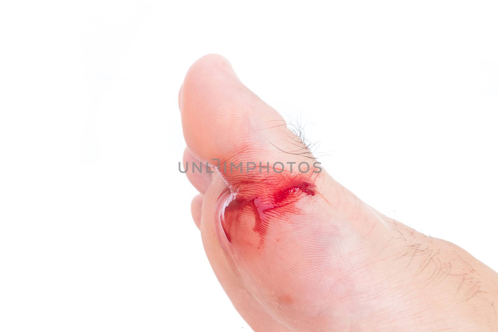 Injured foot, Fresh wound and blood from broken glass, white background
