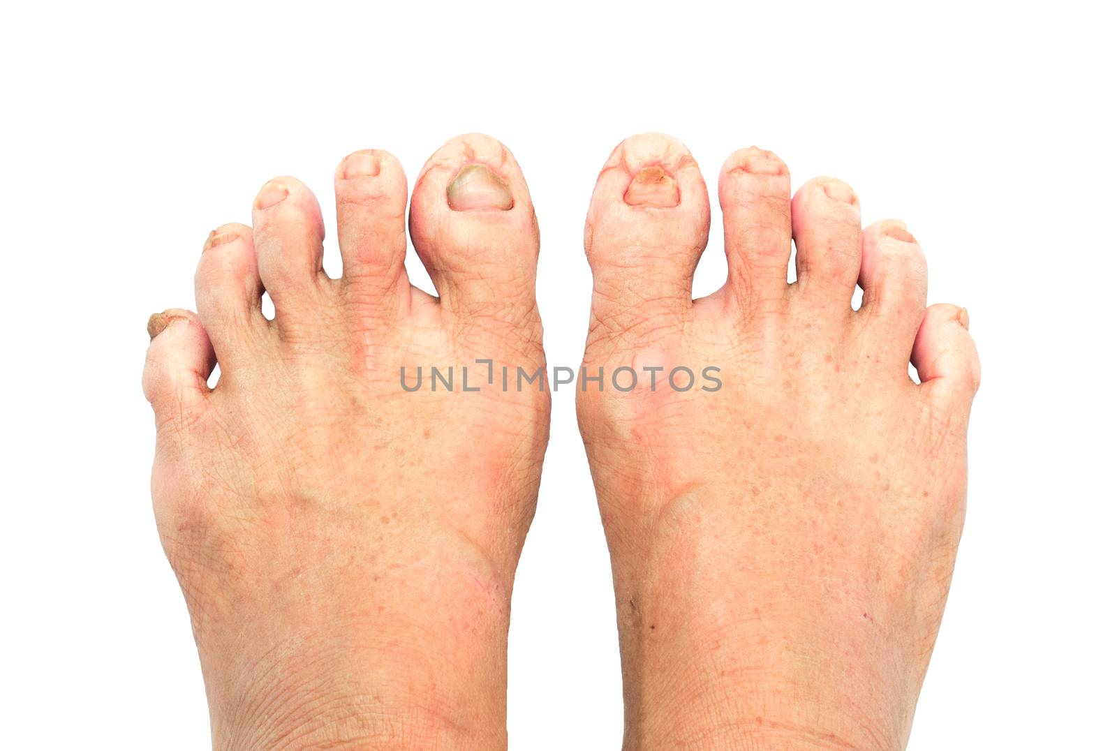 Woman cracked heels with white background, foot healthy concept