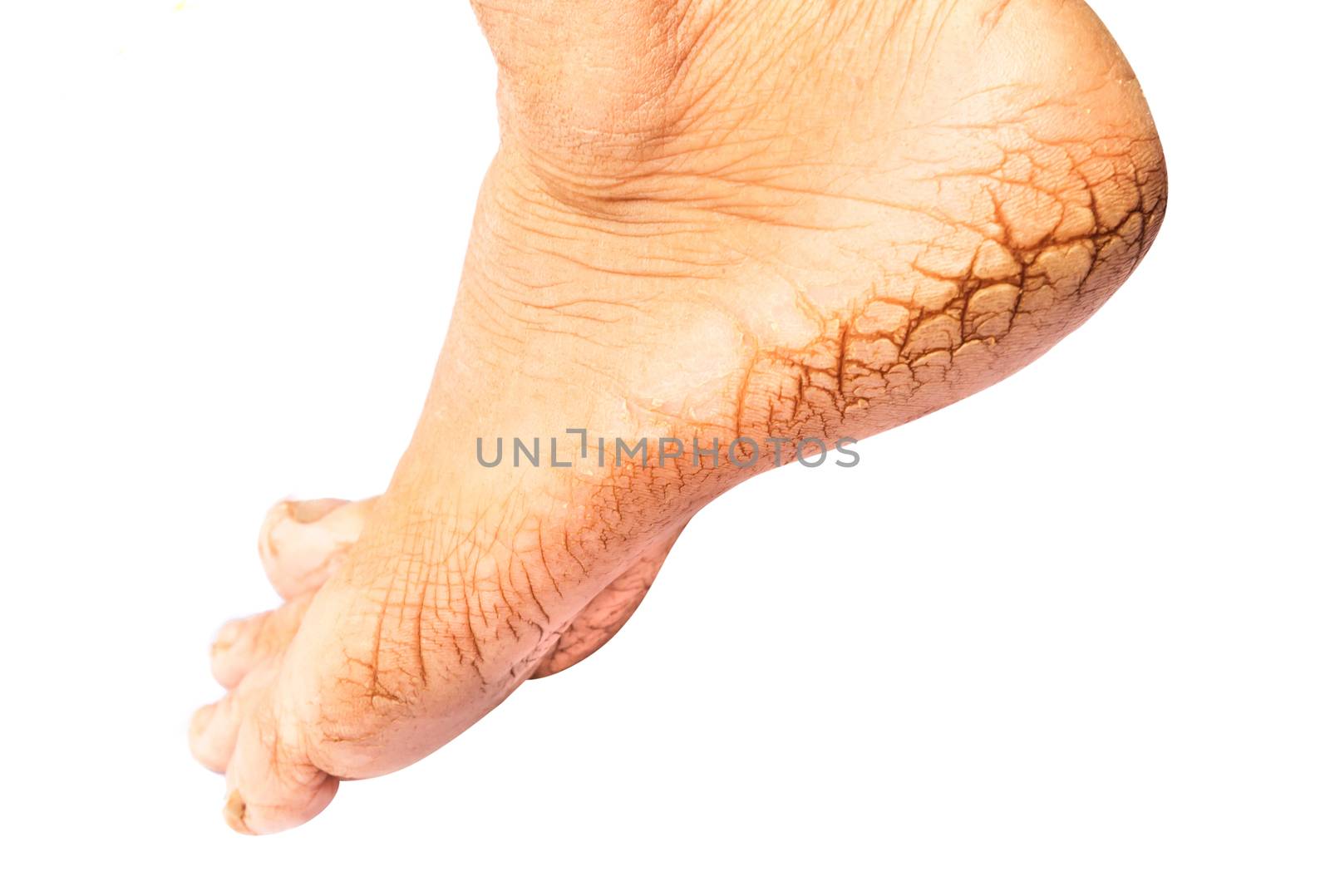 Woman cracked heels with white background, foot healthy concept