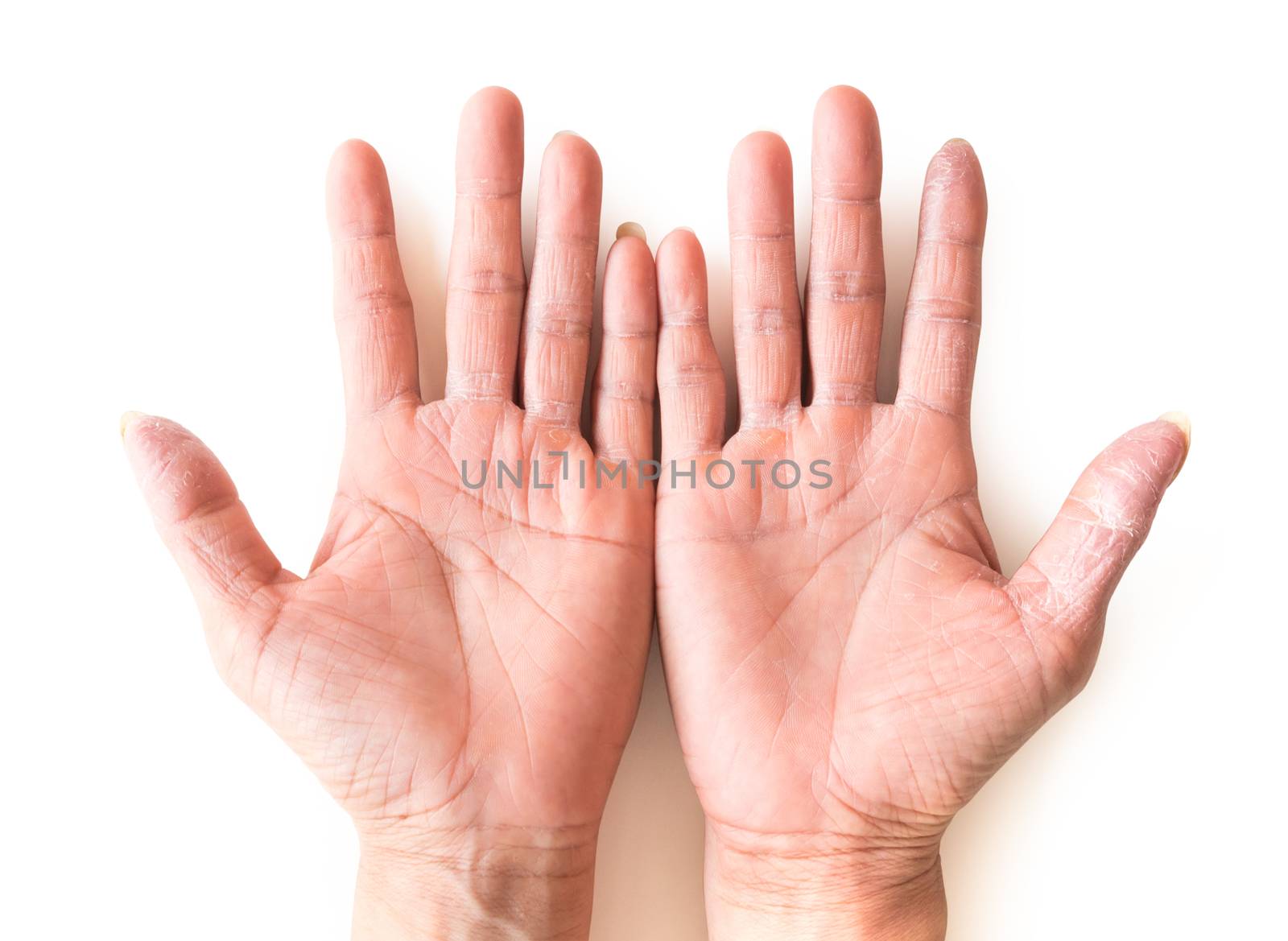Hand atopic dermatitis symptom skin texture on white background 