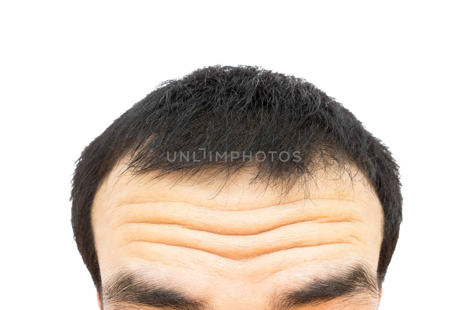 Closeup wrinkles on forehead young man, Hair loss for health care concept