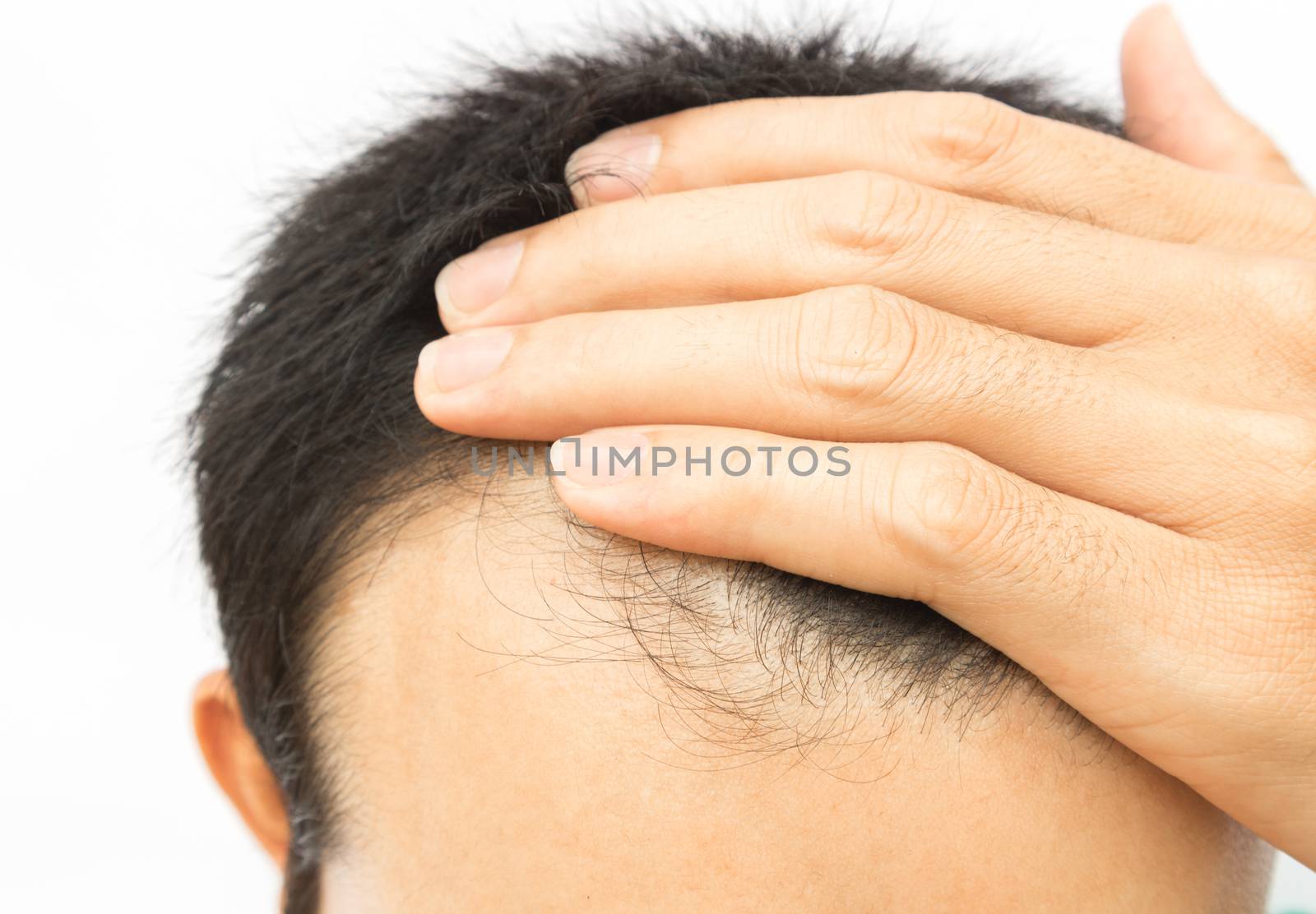 Young man serious hair loss problem for hair loss concept by pt.pongsak@gmail.com