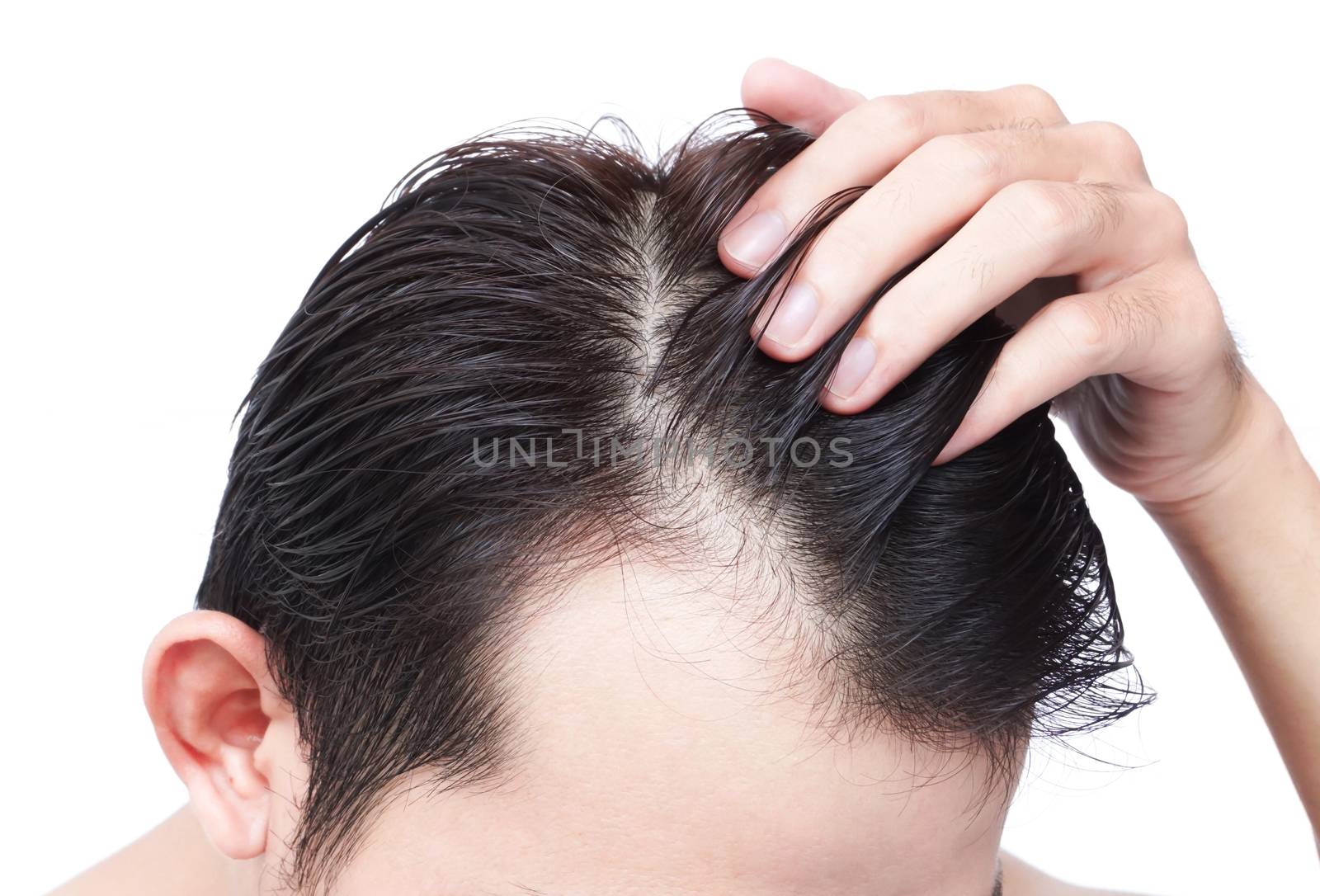 Young man serious hair loss problem for health care shampoo and  by pt.pongsak@gmail.com