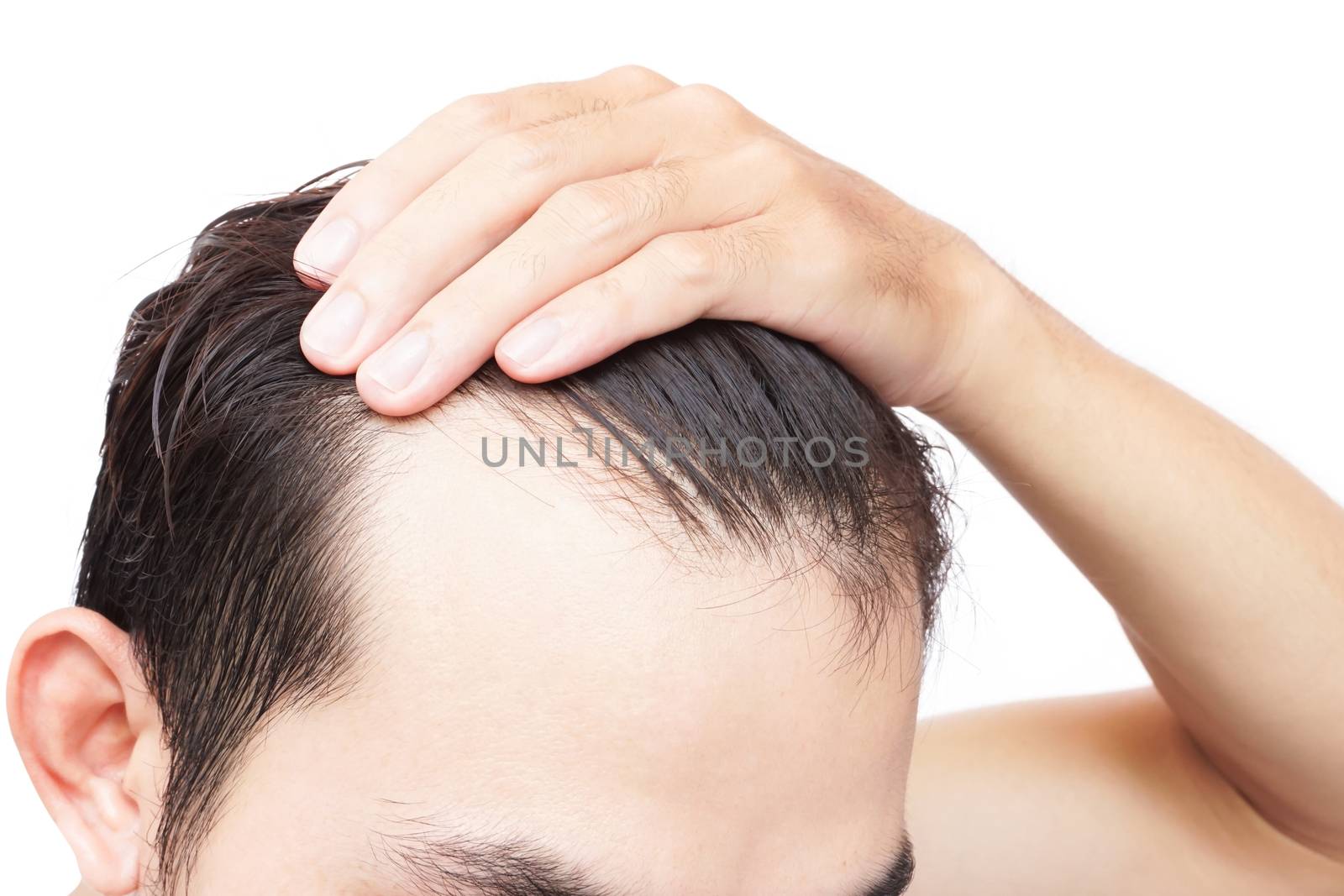 Young man serious hair loss problem for health care shampoo and  by pt.pongsak@gmail.com