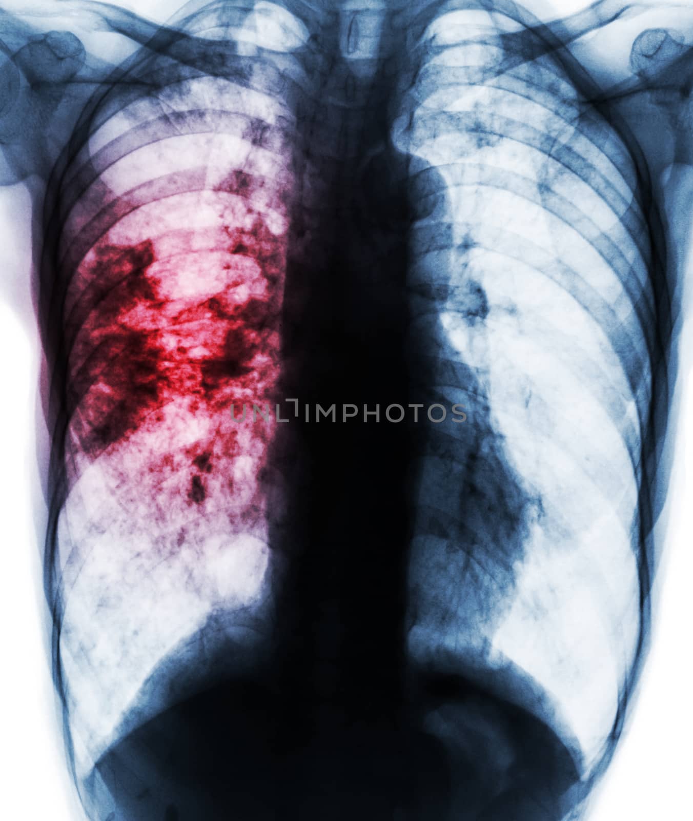 Pulmonary tuberculosis . Film x-ray of chest show patchy infiltrate at right lung due to TB infection by stockdevil