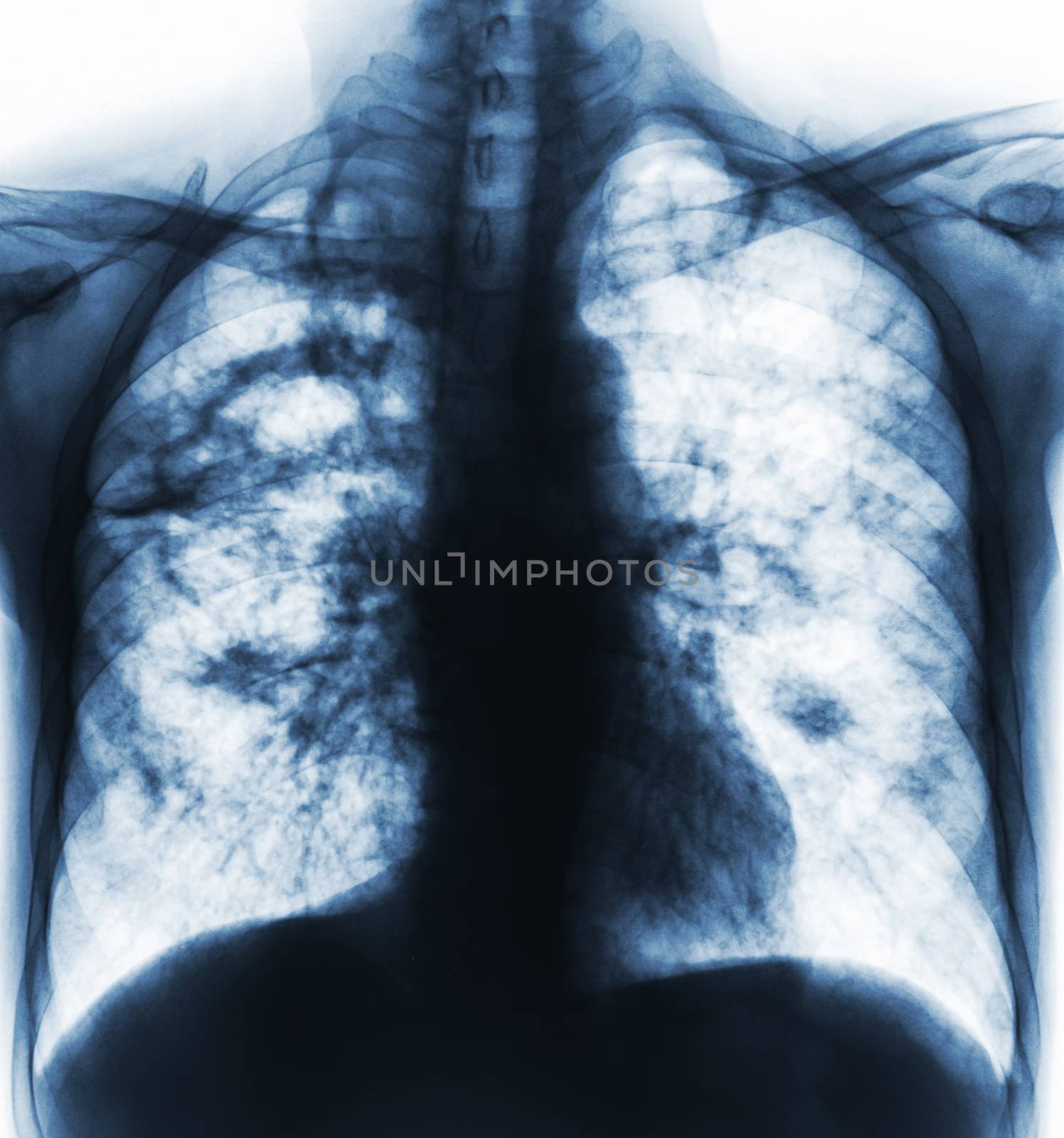 Pulmonary tuberculosis . Film x-ray of chest show cavity at right lung and interstitial infiltrate both lung due to TB infection by stockdevil