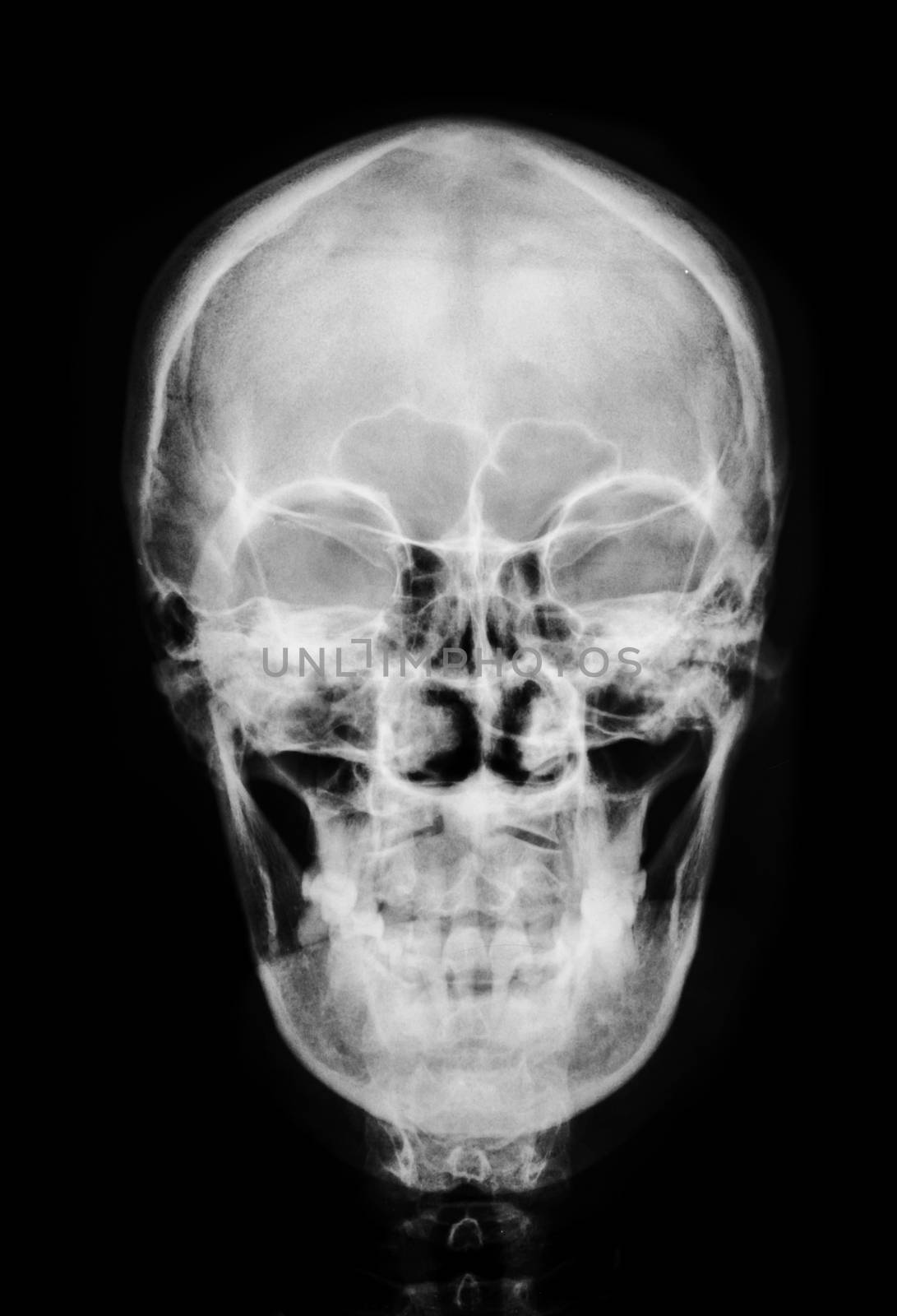 front face skull x-ray image