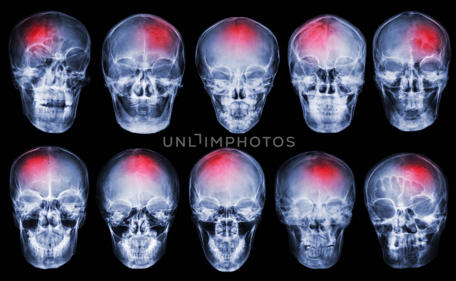 Stroke . Cerebrovascular accident . Set of film x-ray skull by stockdevil