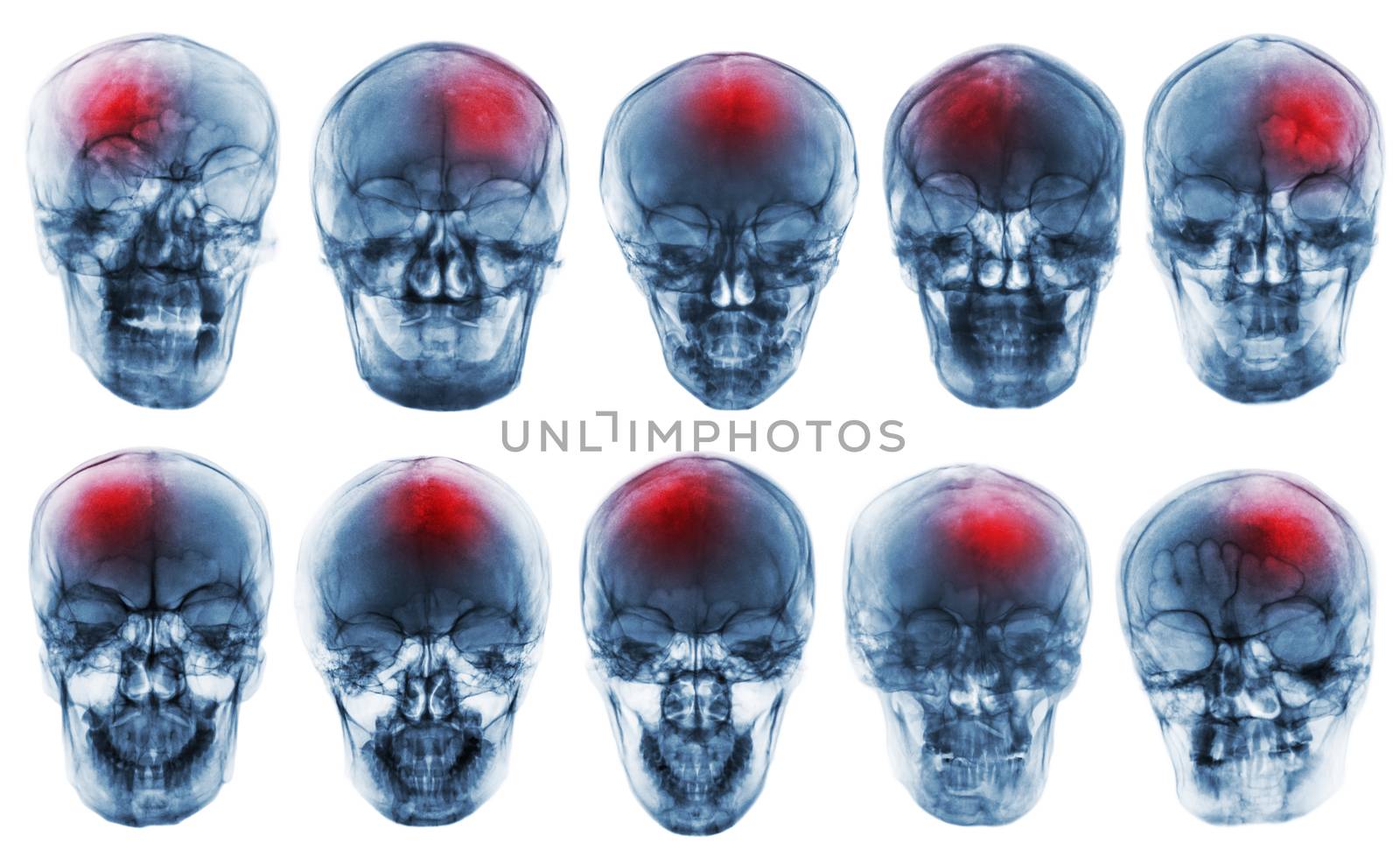 Stroke . Cerebrovascular accident . Set of film x-ray skull .
